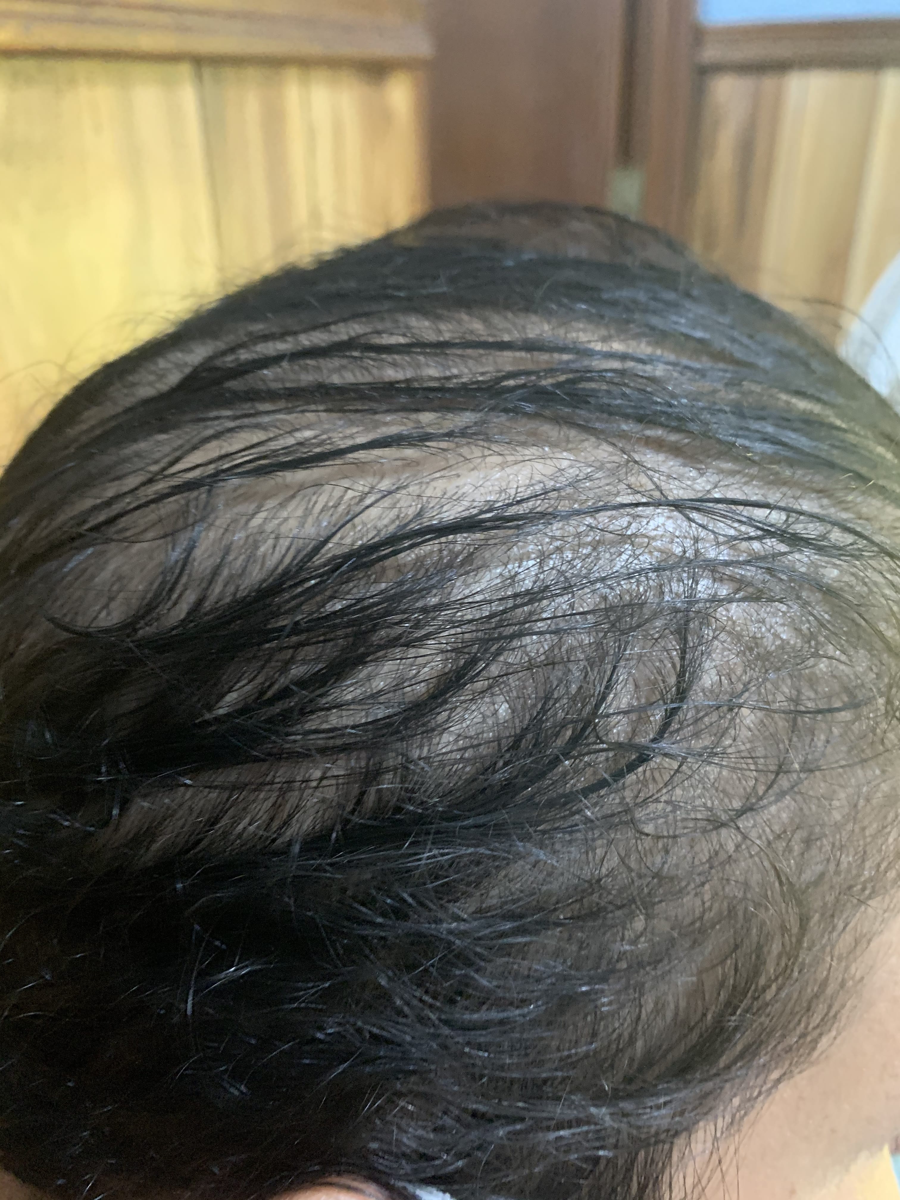 ALOPECIA ANDROGENETICA - Patrón femenino
