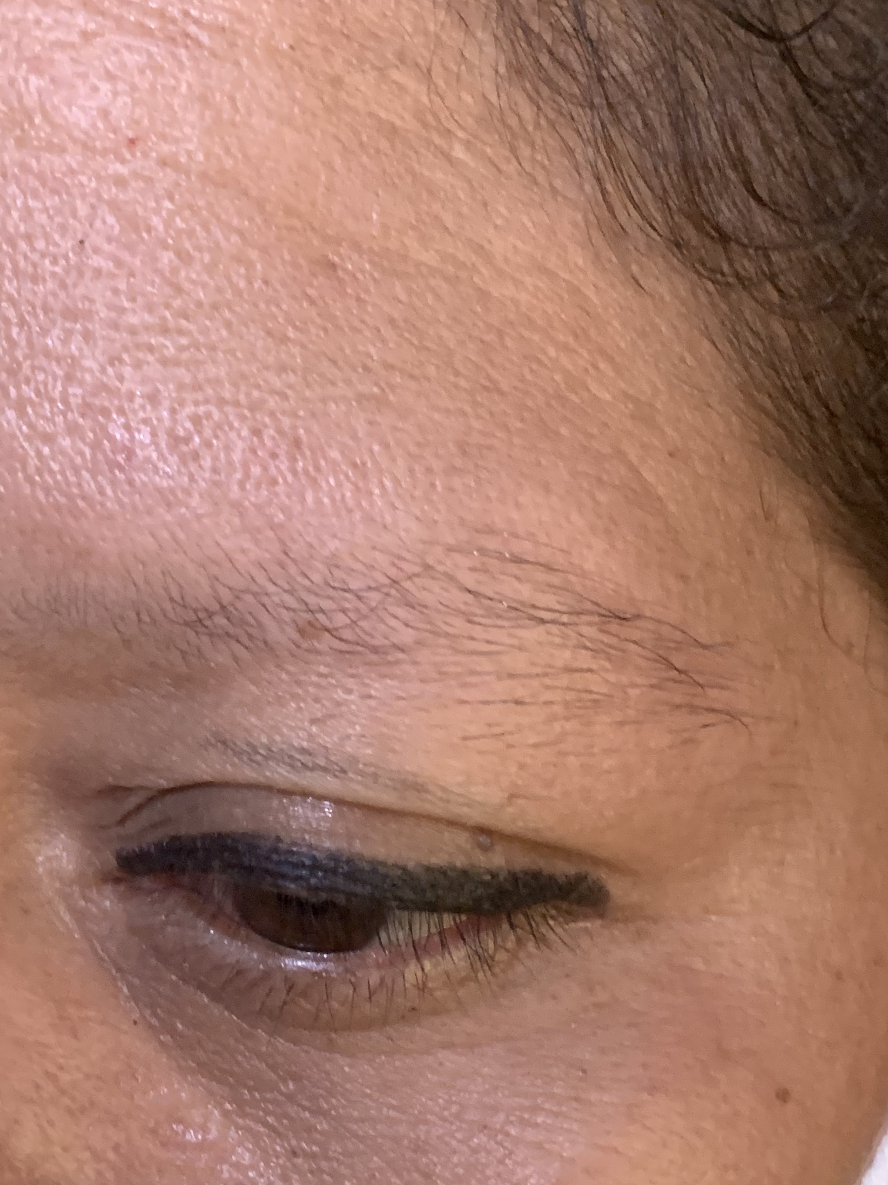 ALOPECIA ANDROGENETICA - Afectacion de cejas