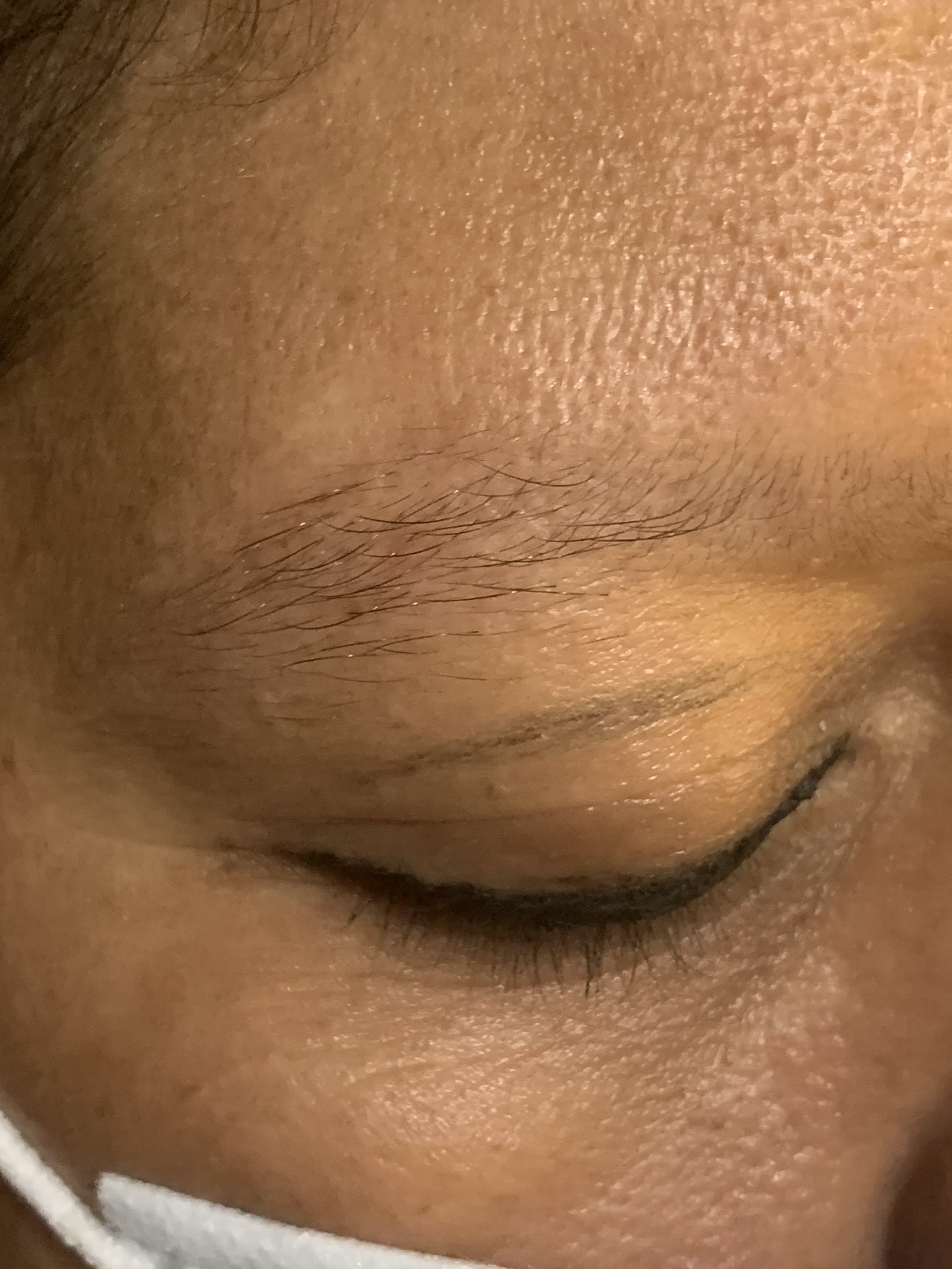 ALOPECIA ANDROGENETICA - Afectacion de cejas