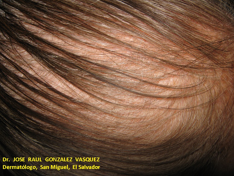 ALOPECIA ANDROGENETICA - Patrón femenino