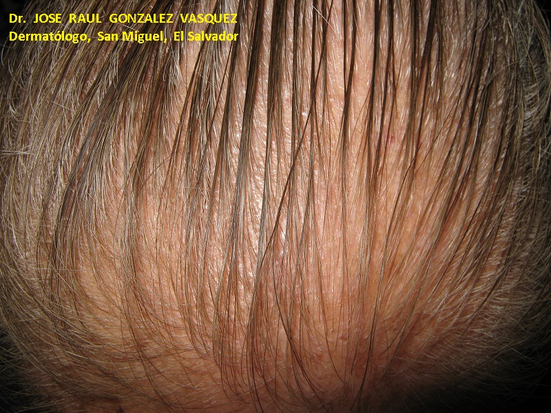 ALOPECIA ANDROGENETICA - Patrón femenino