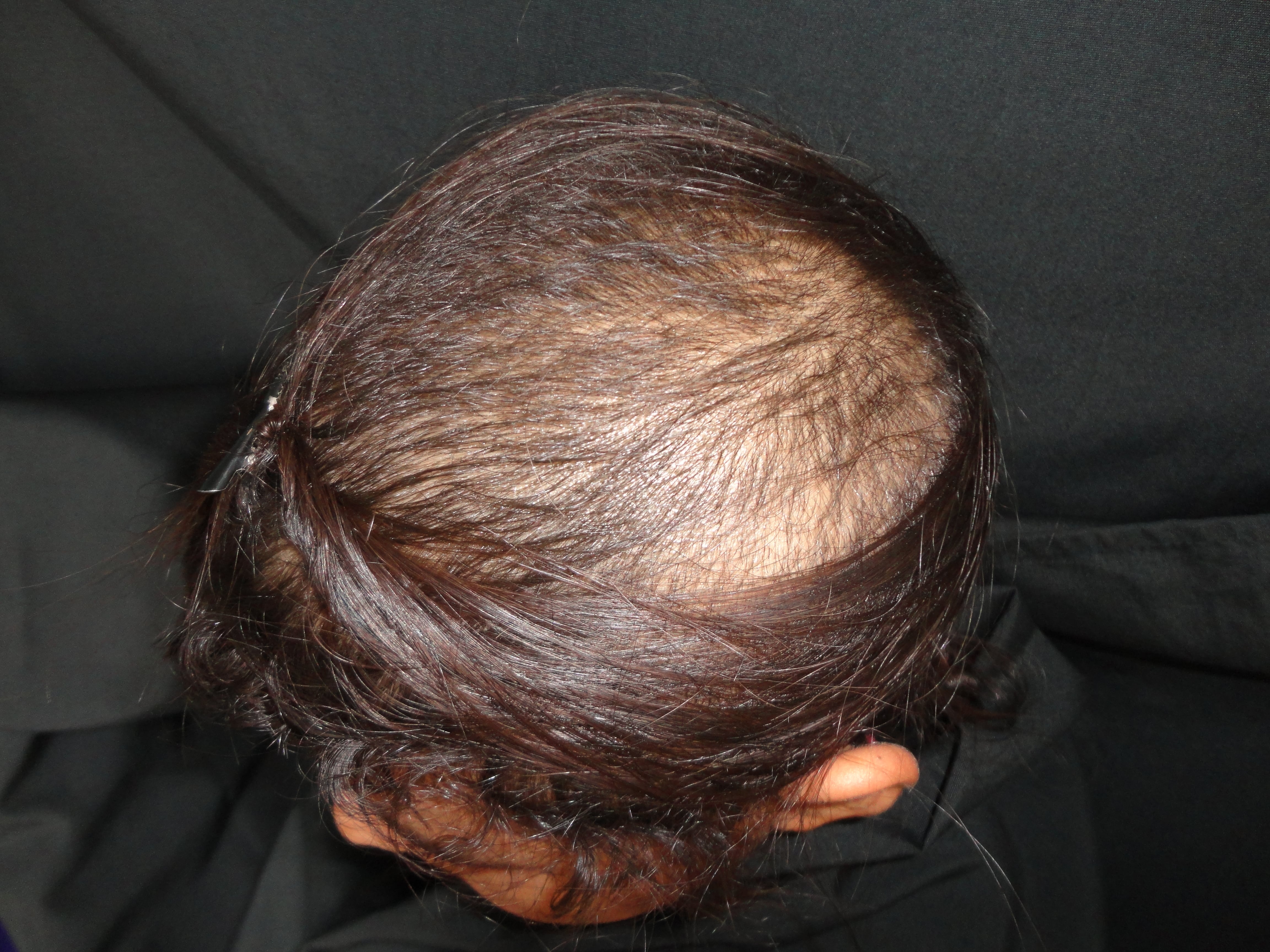 ALOPECIA ANDROGENETICA - Patrón femenino