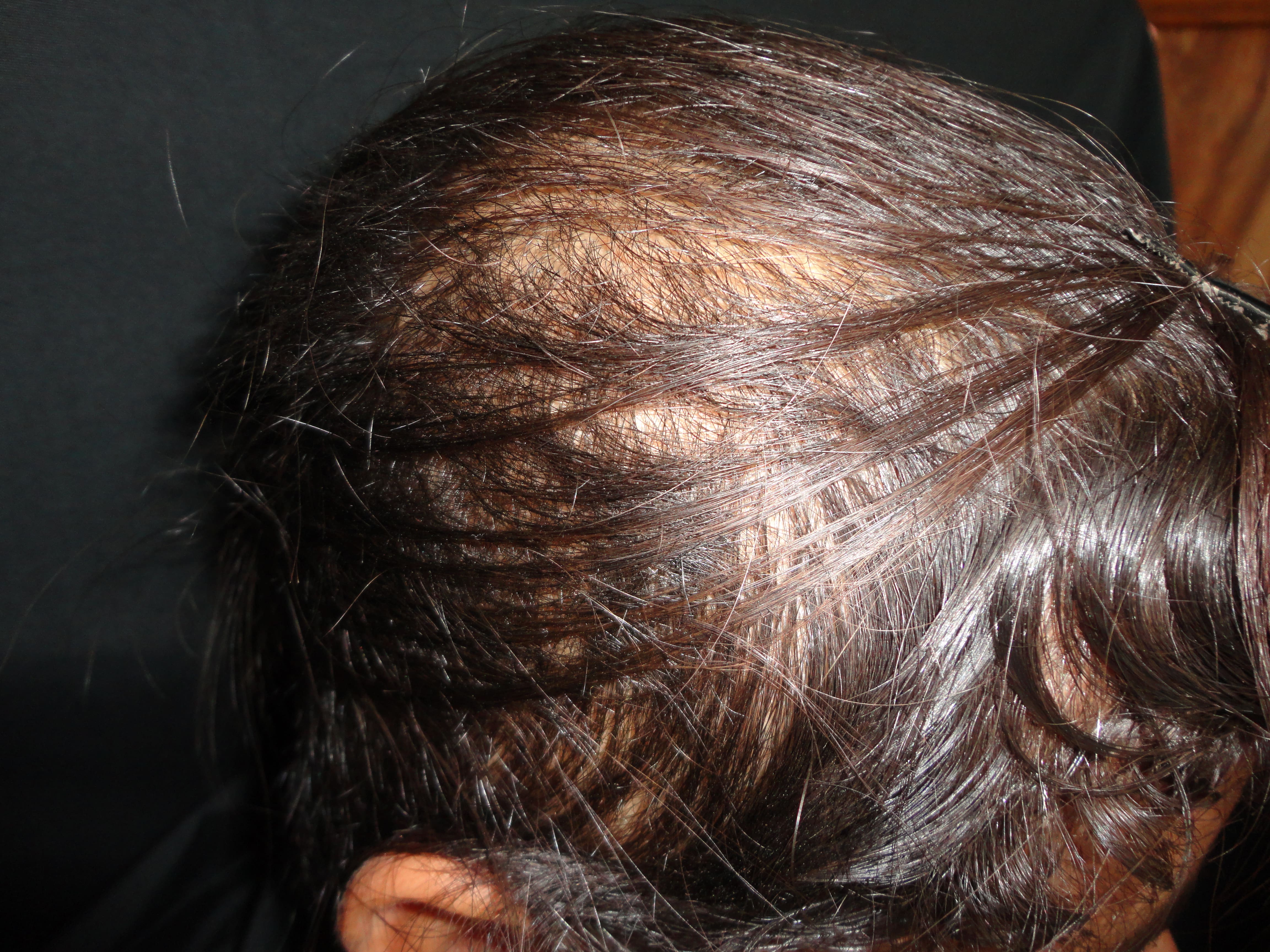 ALOPECIA ANDROGENETICA - Patrón femenino