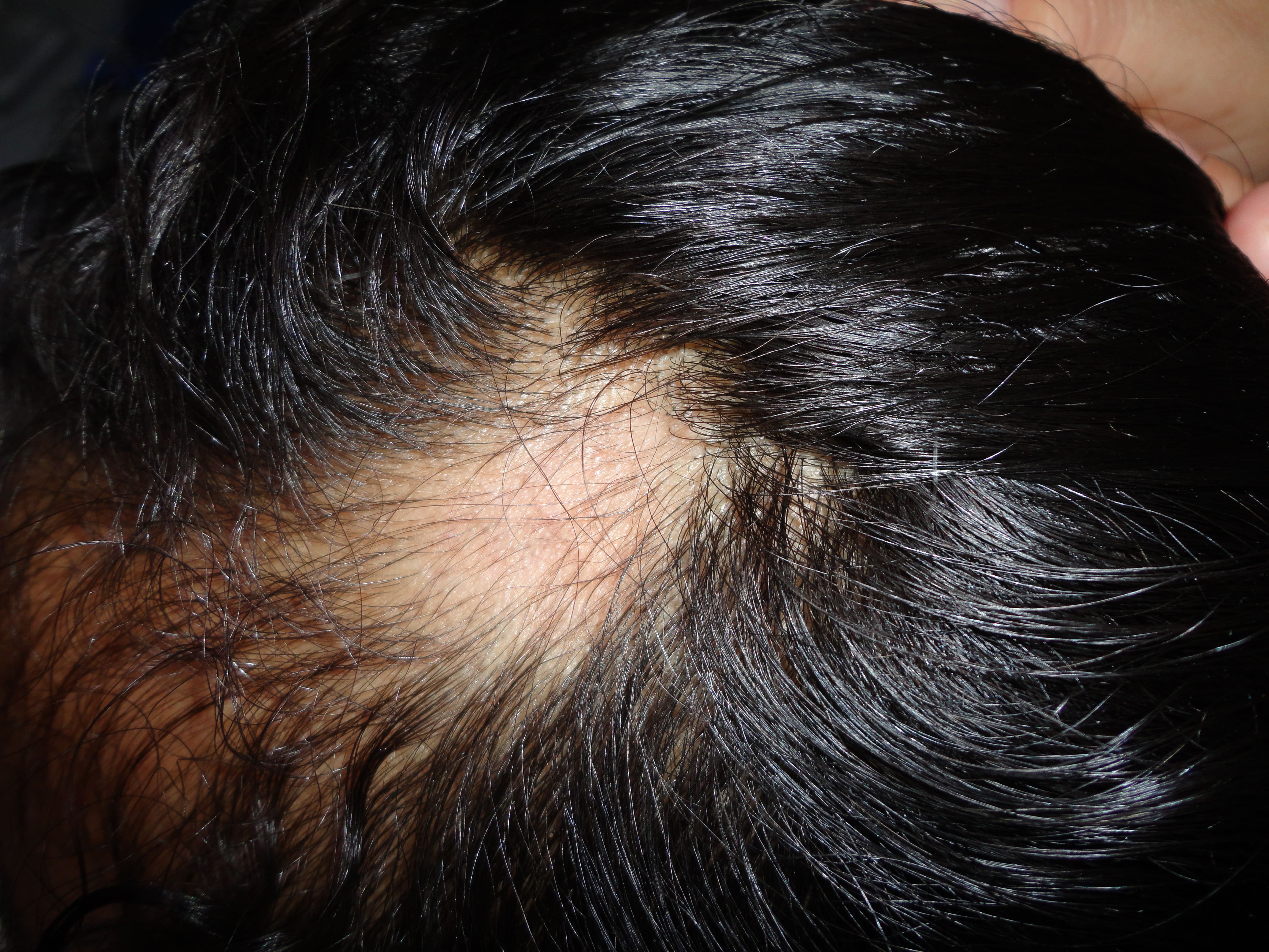ALOPECIA AREATA