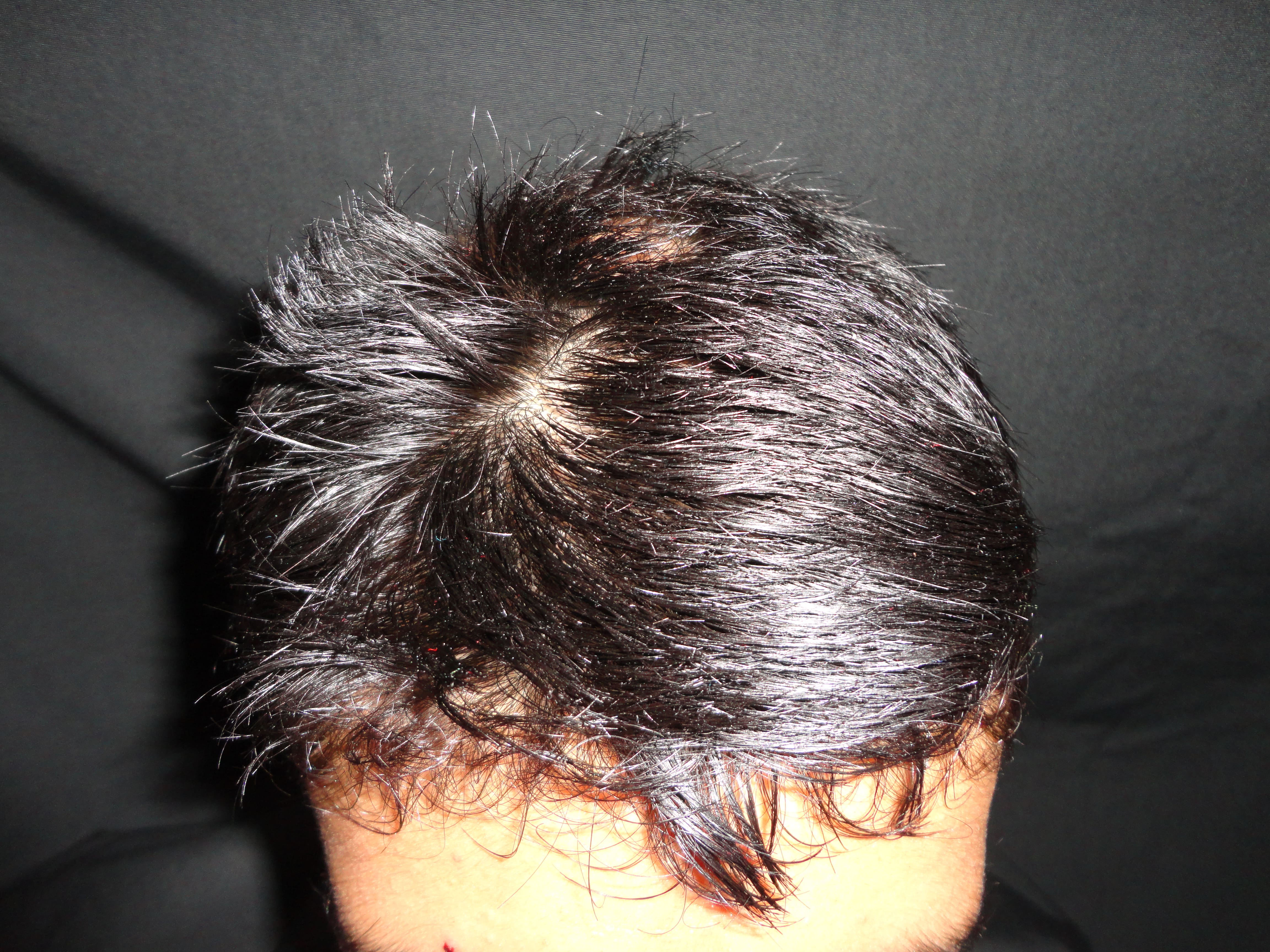 ALOPECIA AREATA