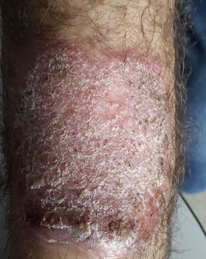 CROMOBLASTOMICOSIS del antebrazo