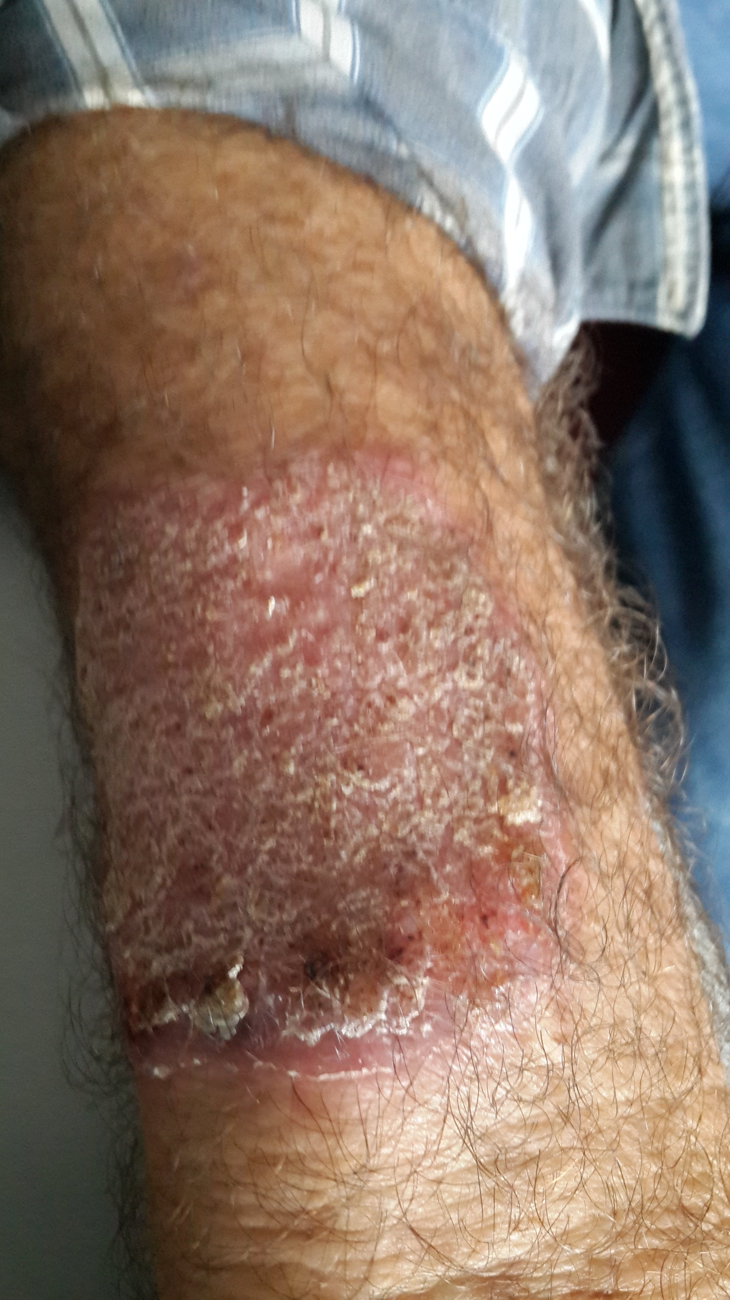 CROMOBLASTOMICOSIS del antebrazo