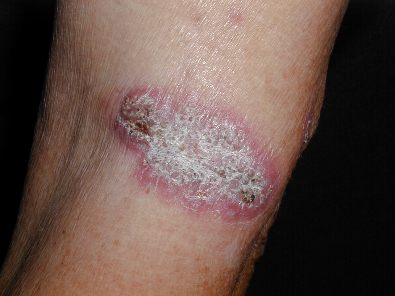ESPOROTRICOSIS FIJA