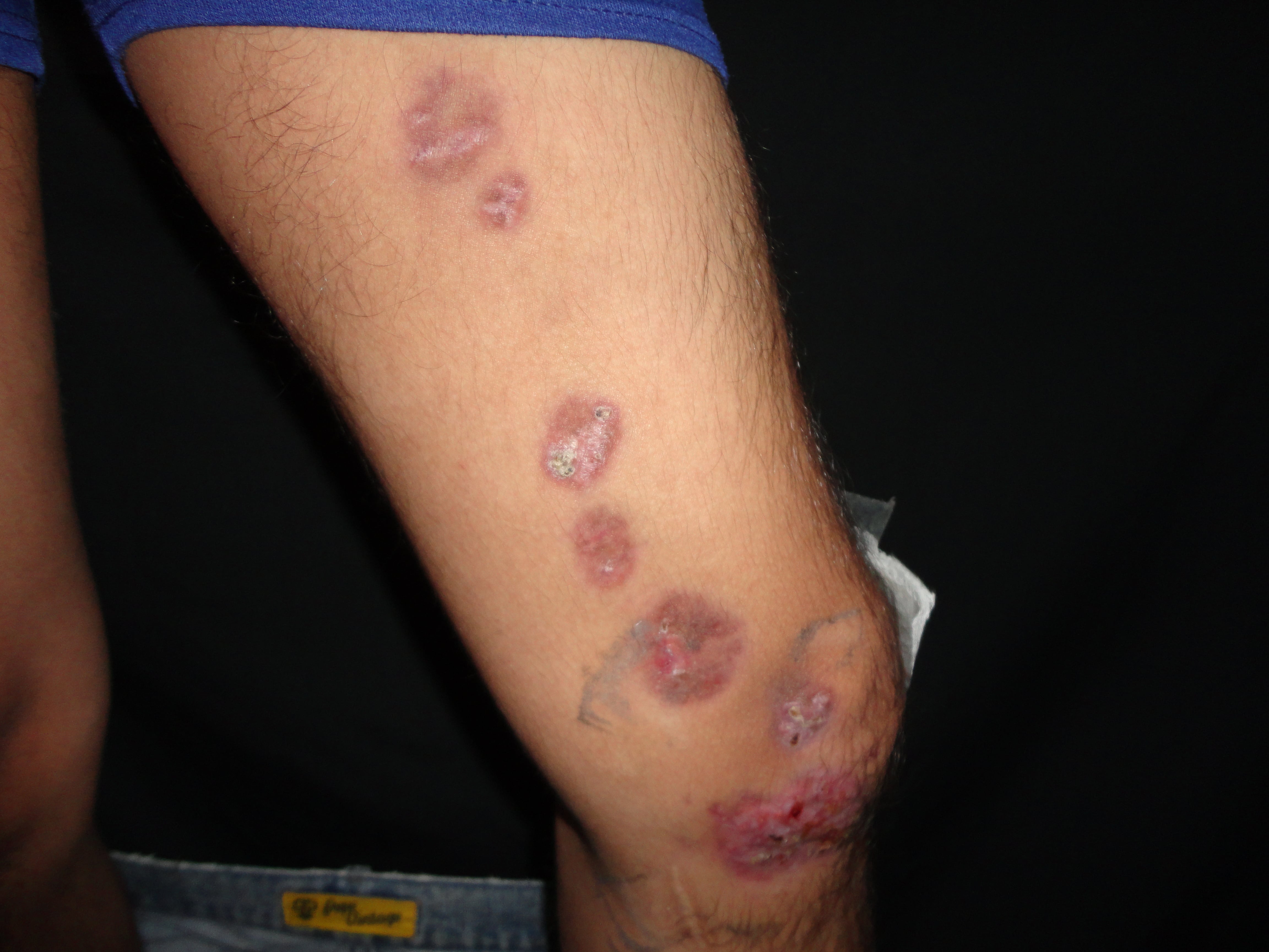 ESPOROTRICOSIS LINFANGITICA
