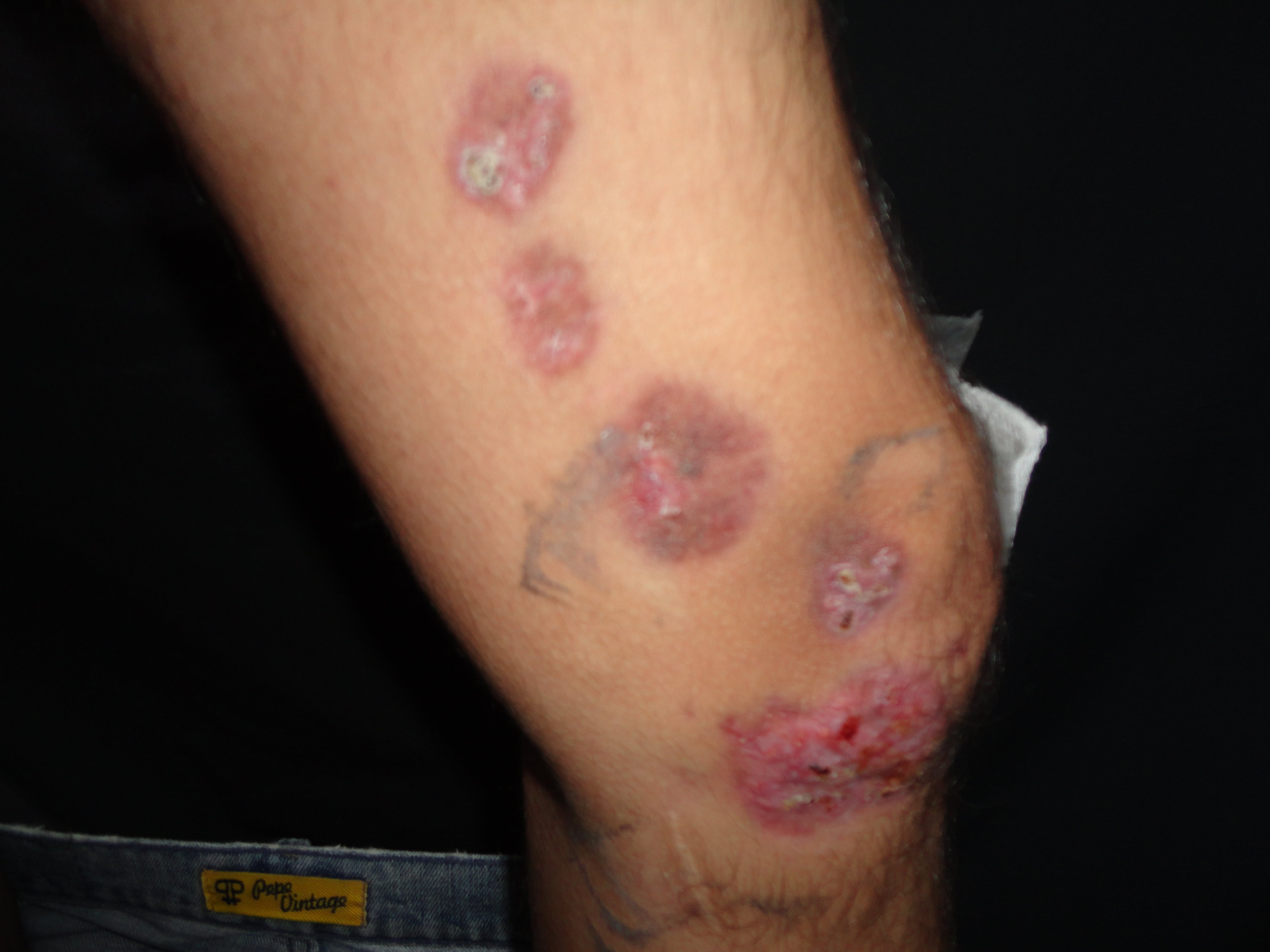 ESPOROTRICOSIS LINFANGITICA