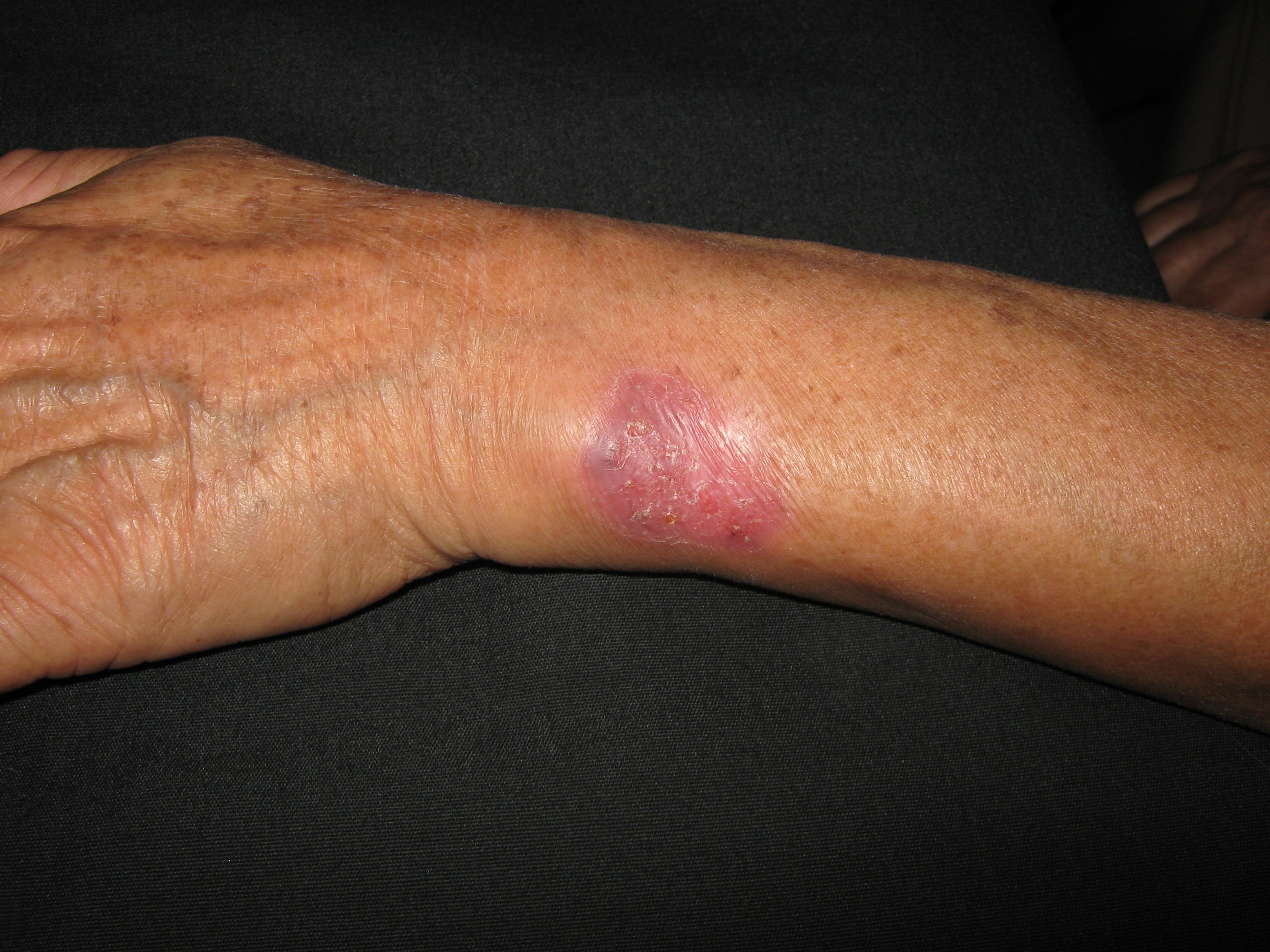 ESPOROTRICOSIS FIJA