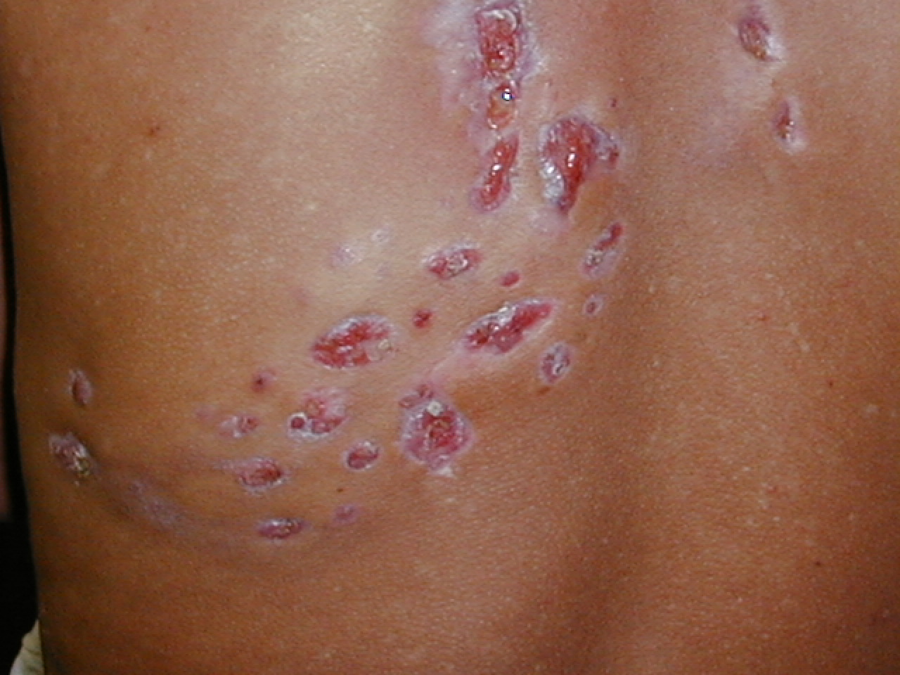 MICETOMA DEL DORSO - Lado izquierdo