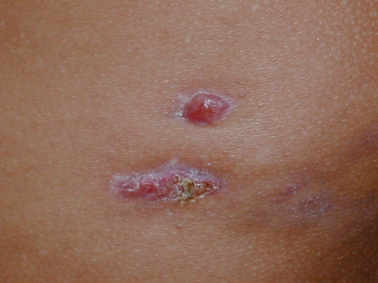 MICETOMA DEL DORSO - Lado izquierdo