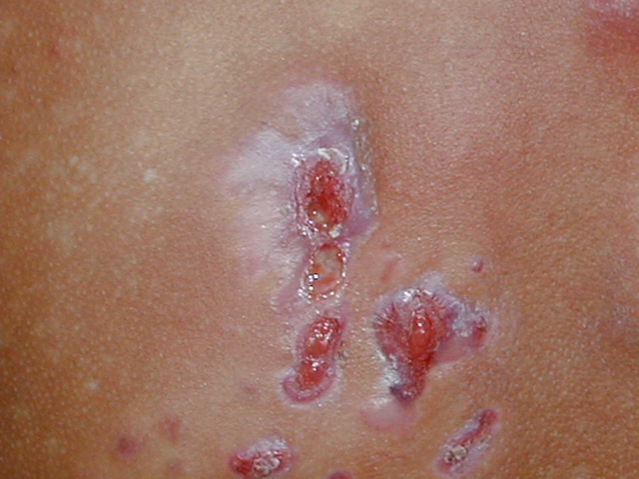 MICETOMA DEL DORSO - Lado izquierdo