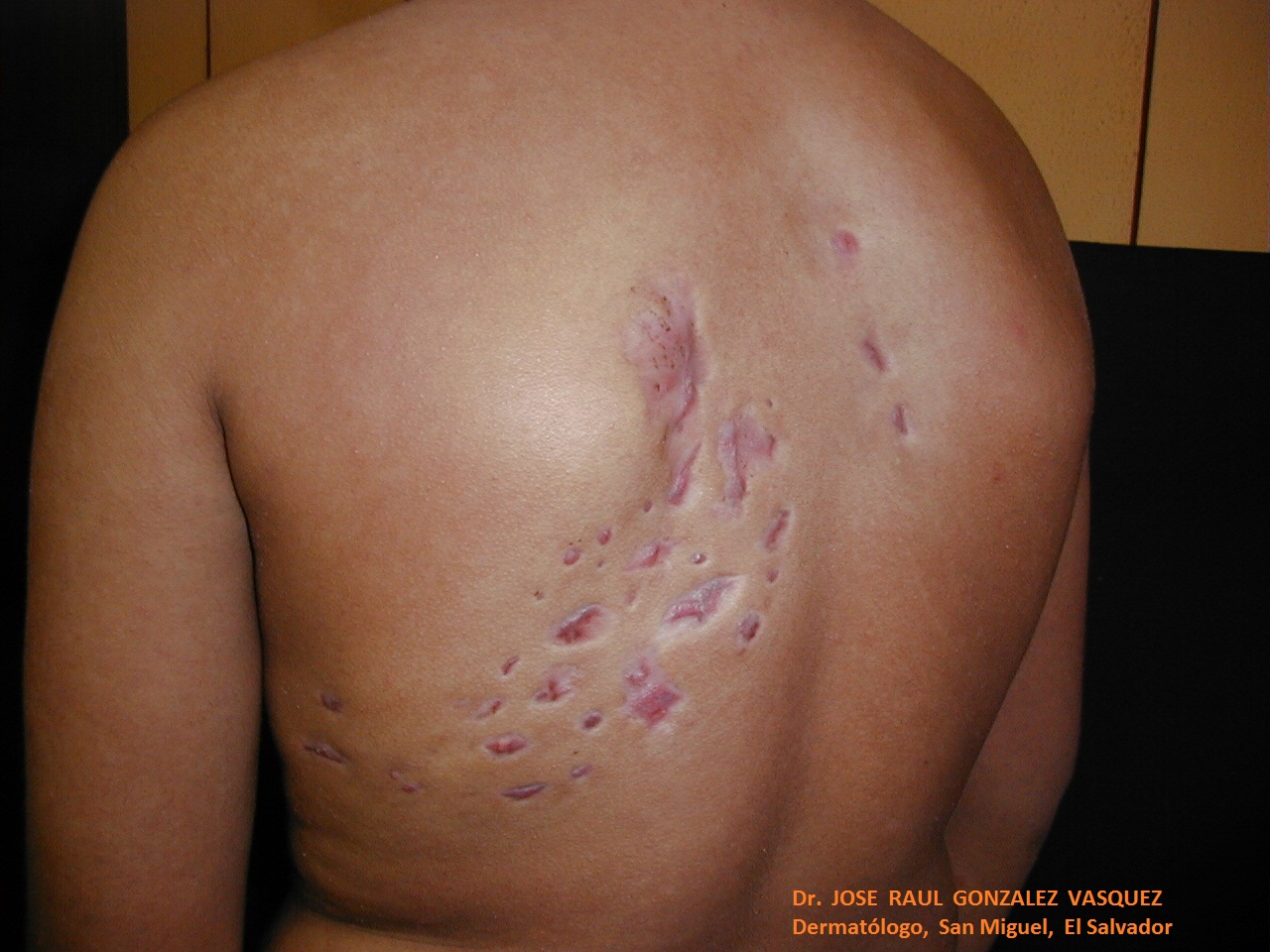 MICETOMA DEL DORSO - Lado izquierdo - 9 años después