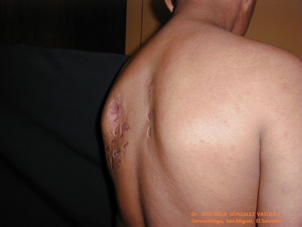 MICETOMA DEL DORSO - Lado izquierdo - 9 años después