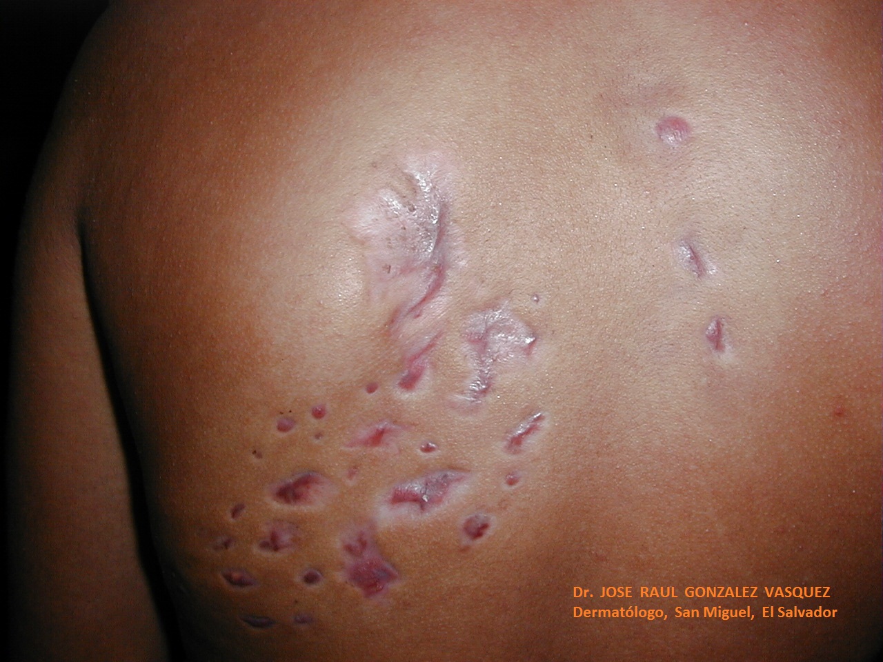 MICETOMA DEL DORSO - Lado izquierdo - 9 años después