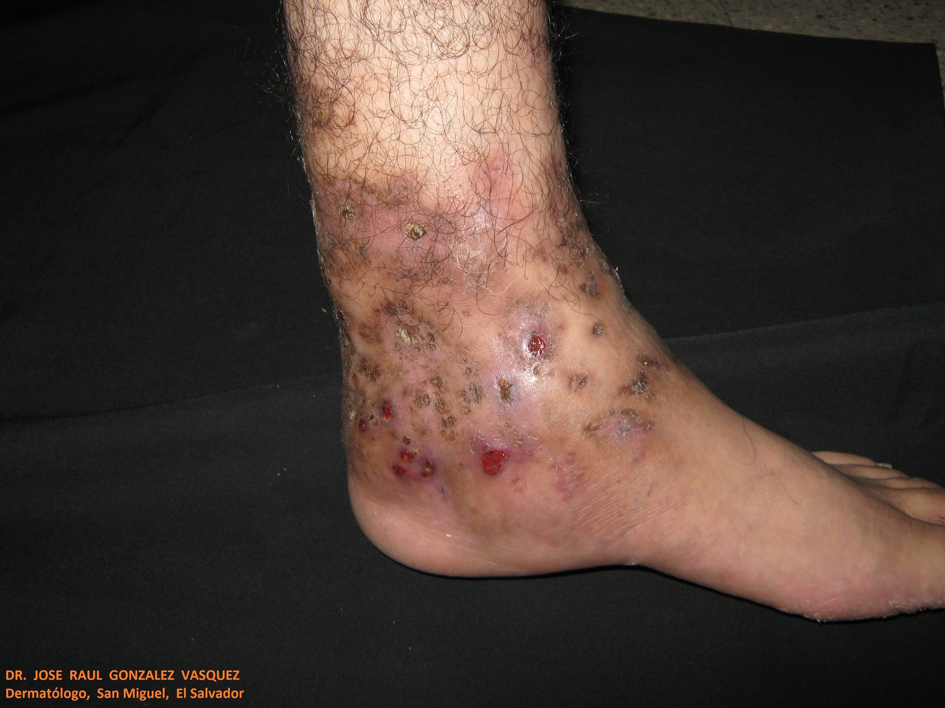 MICETOMA Pierna y pie izquierdo