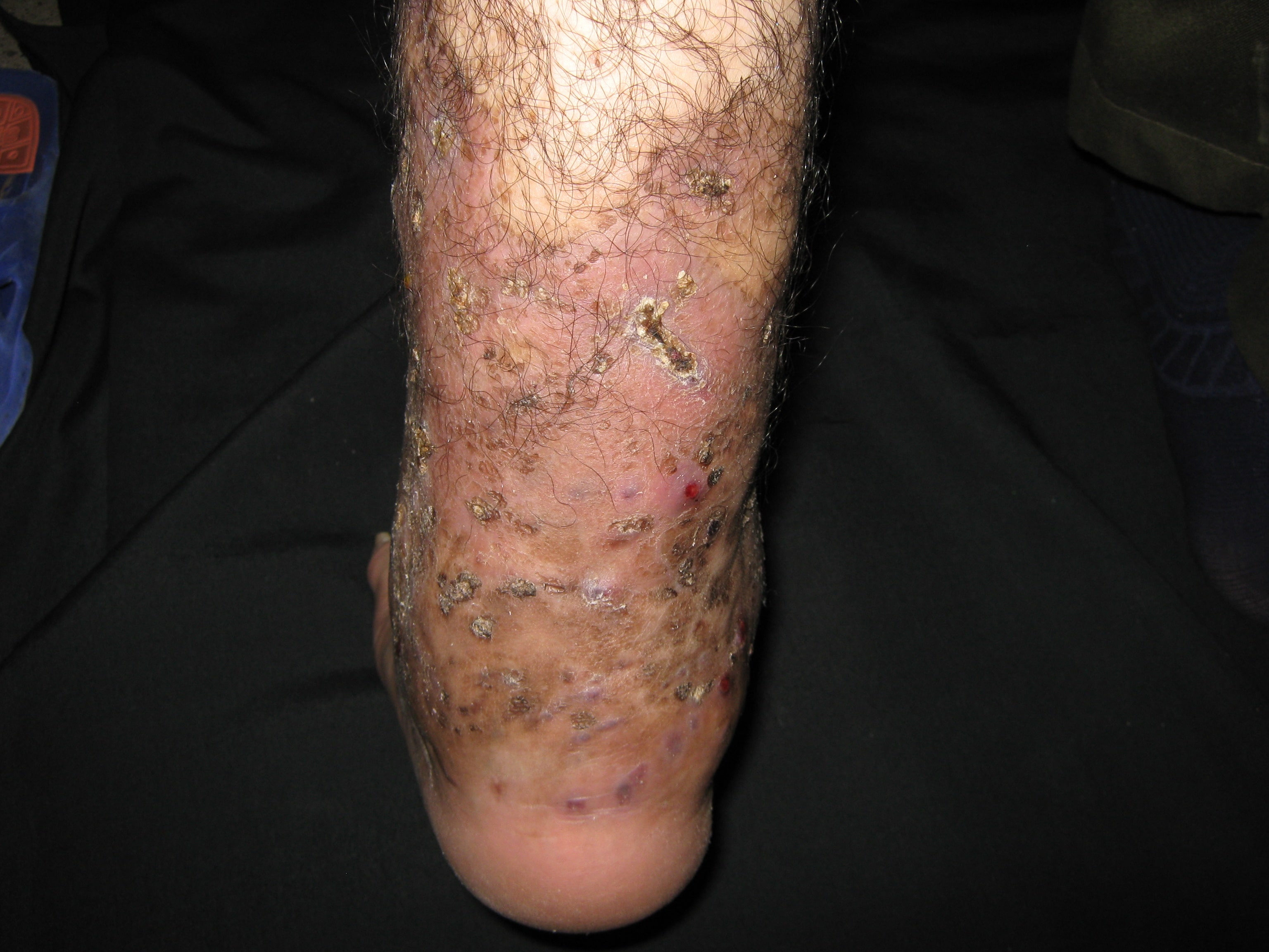 MICETOMA Pierna y pie izquierdo