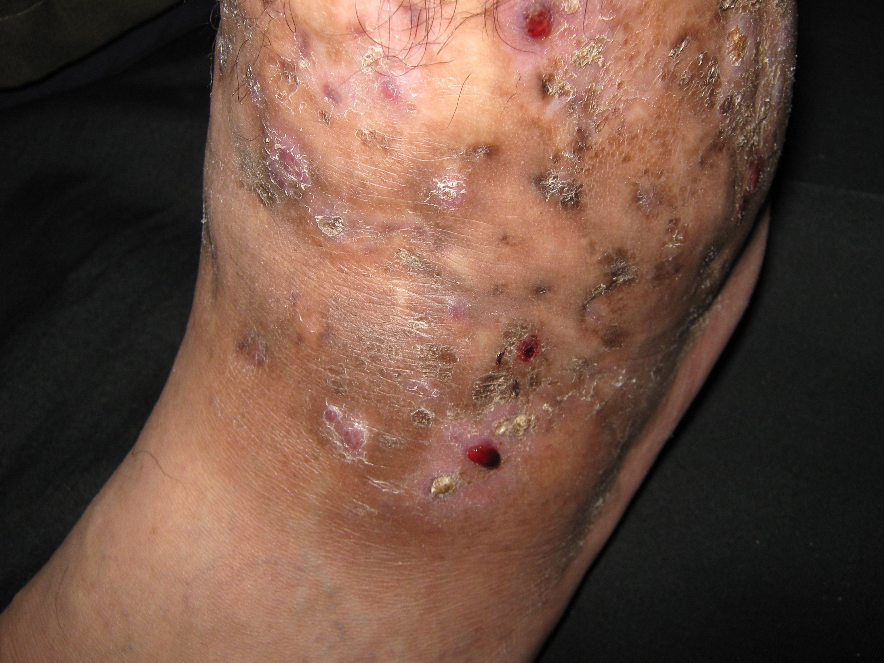 MICETOMA Pierna y pie izquierdo