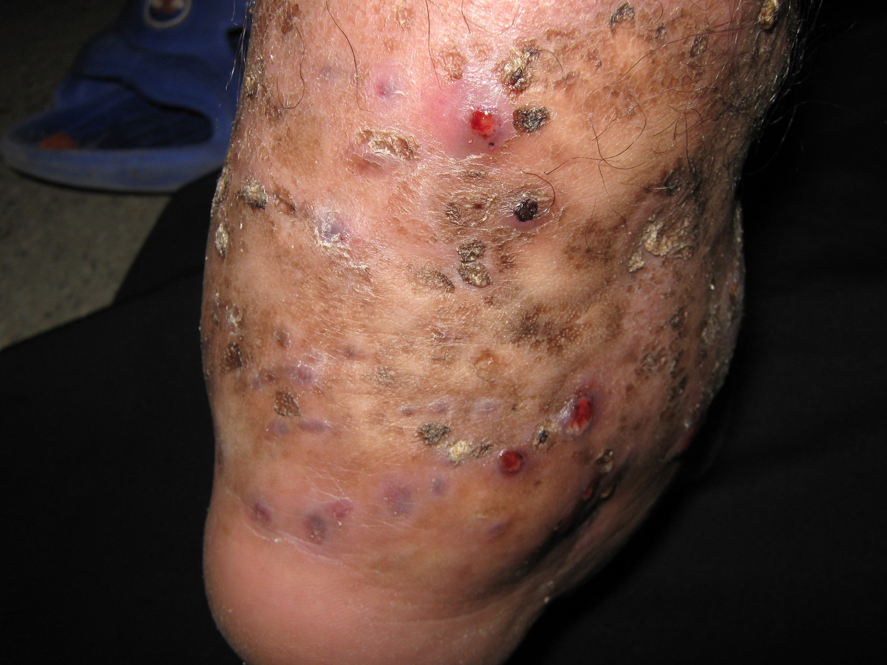 MICETOMA Pierna y pie izquierdo