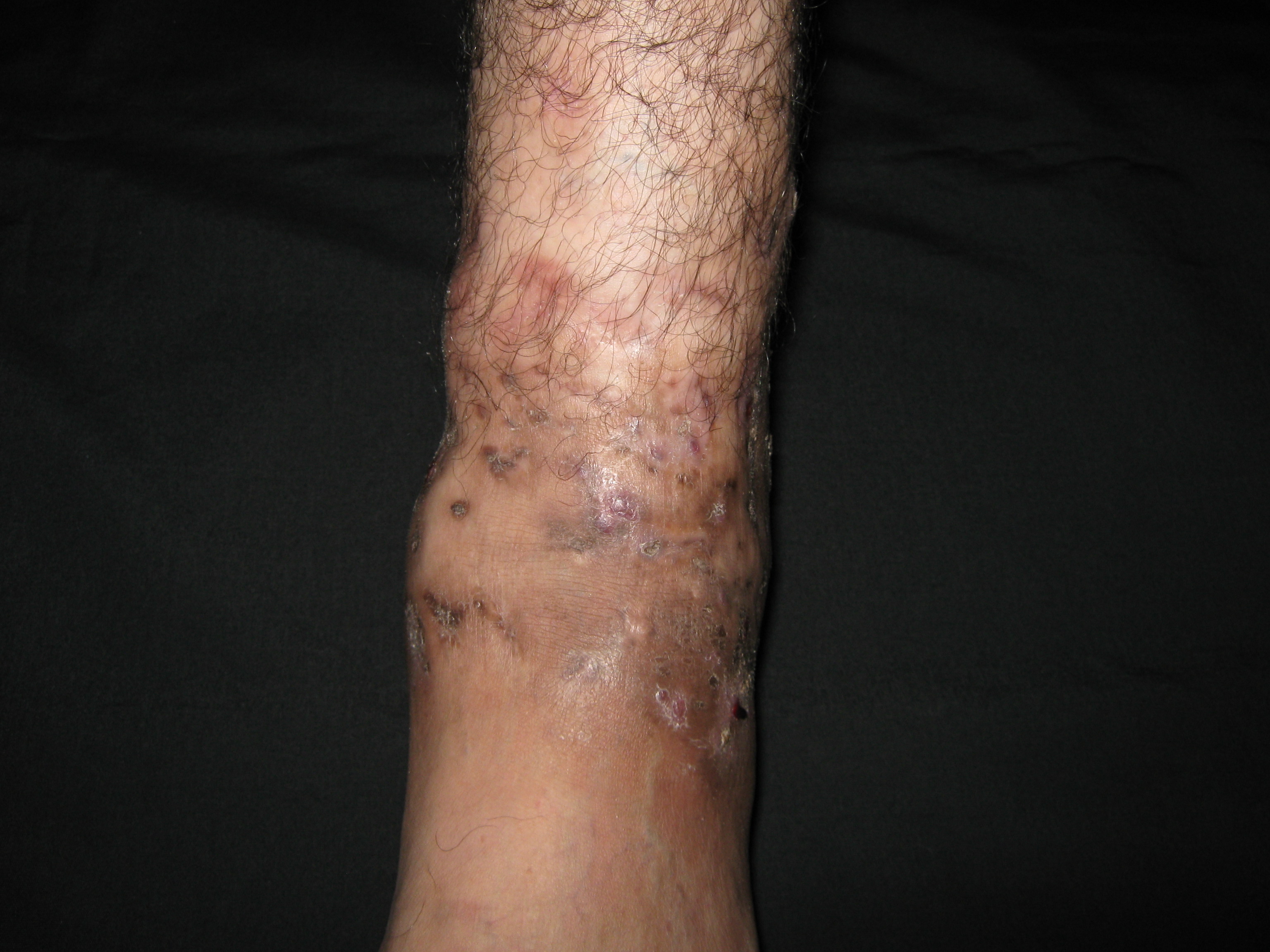 MICETOMA Pierna y pie izquierdo