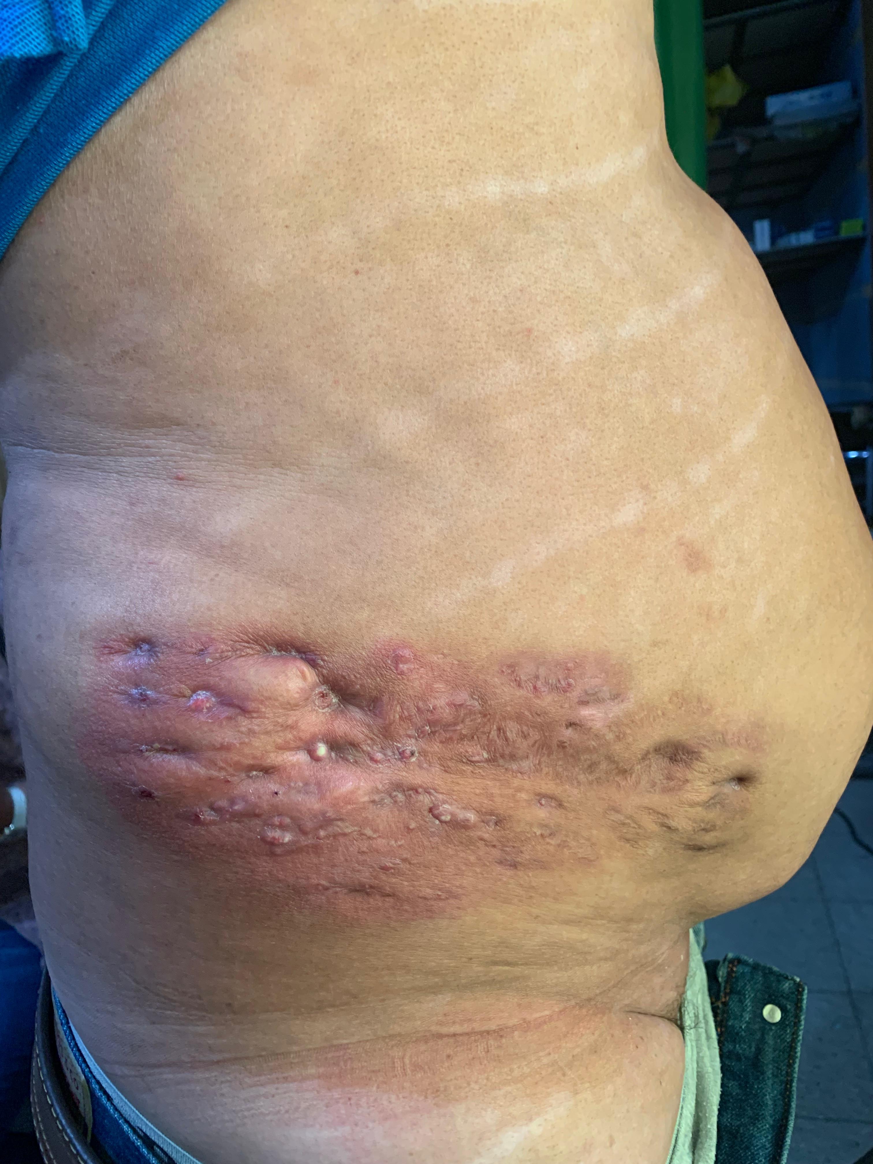 MICETOMA Abdomen - 5 -Sept -2023