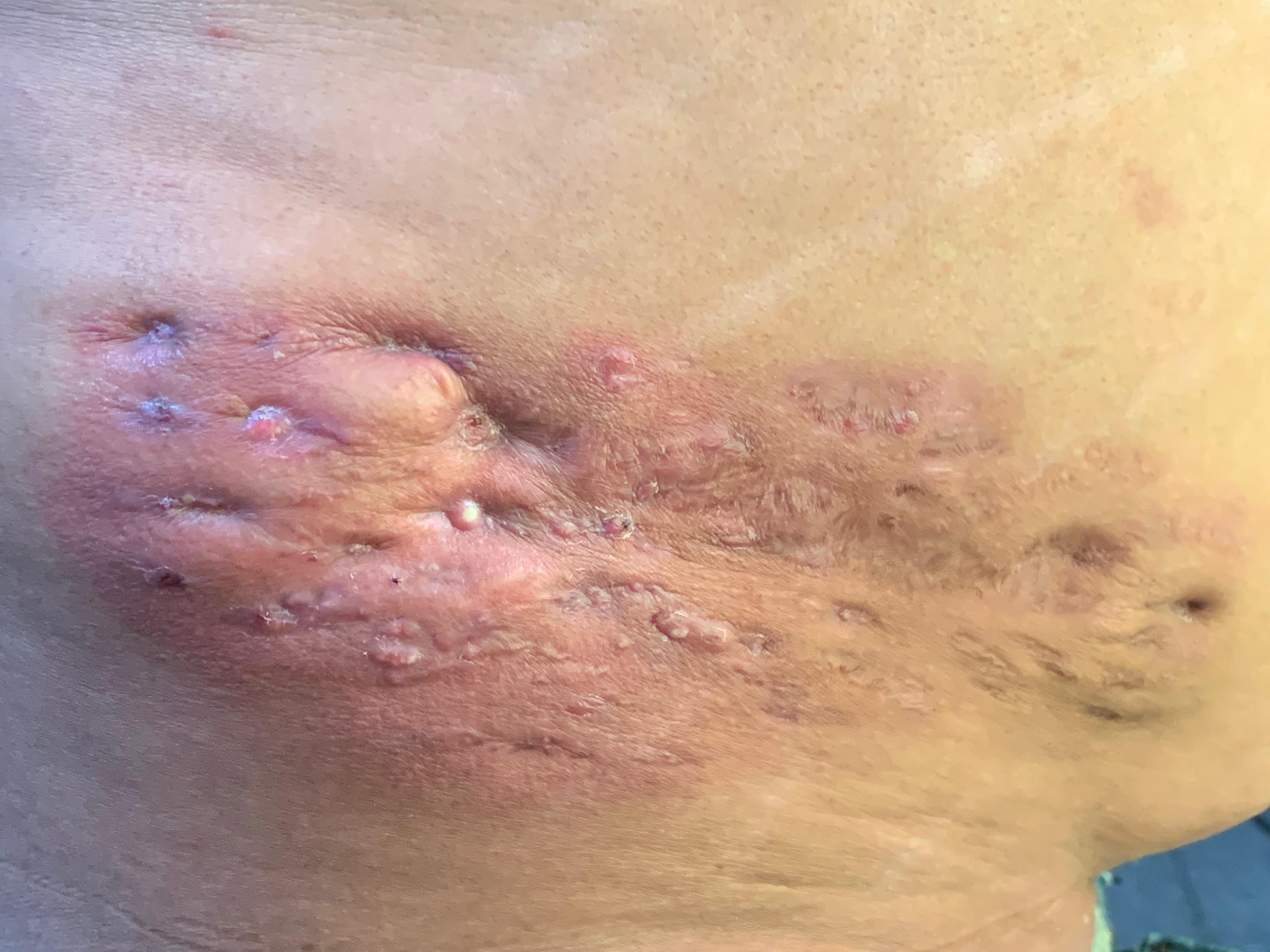 MICETOMA Abdomen - 5 -Sept -2023