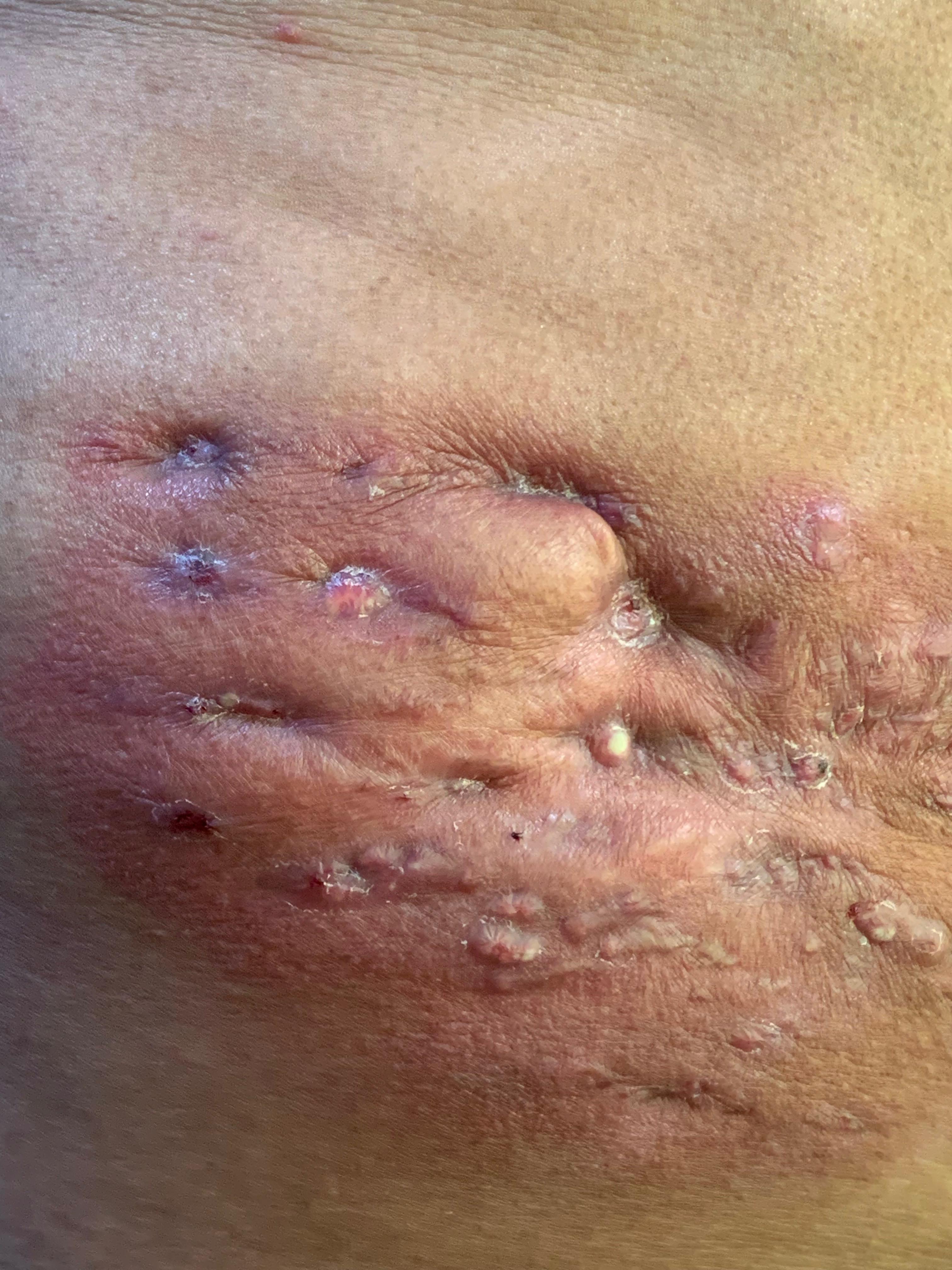 MICETOMA Abdomen - 5 -Sept -2023