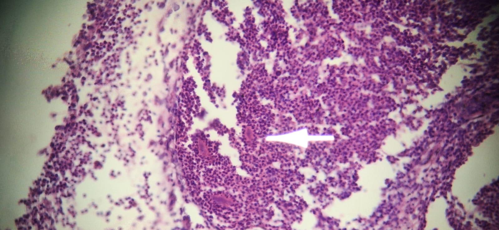 MICETOMA Abdomen - Histopatología - 5 -Sept -2023