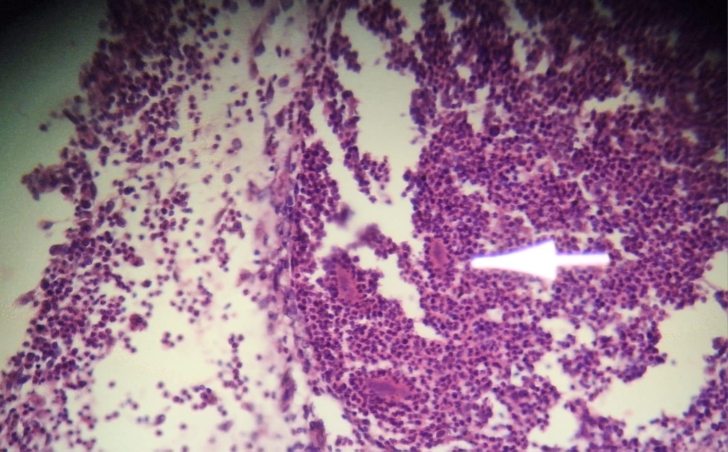 MICETOMA Abdomen - Histopatología - 5 -Sept -2023