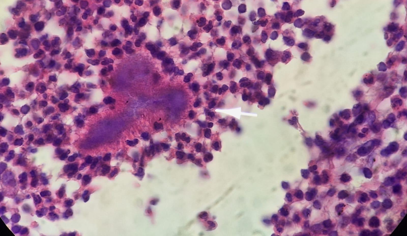 MICETOMA Abdomen - Histopatología - 5 -Sept -2023