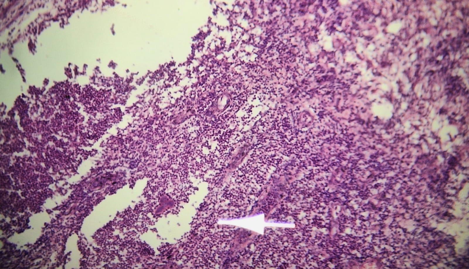 MICETOMA Abdomen - Histopatología - 5 -Sept -2023