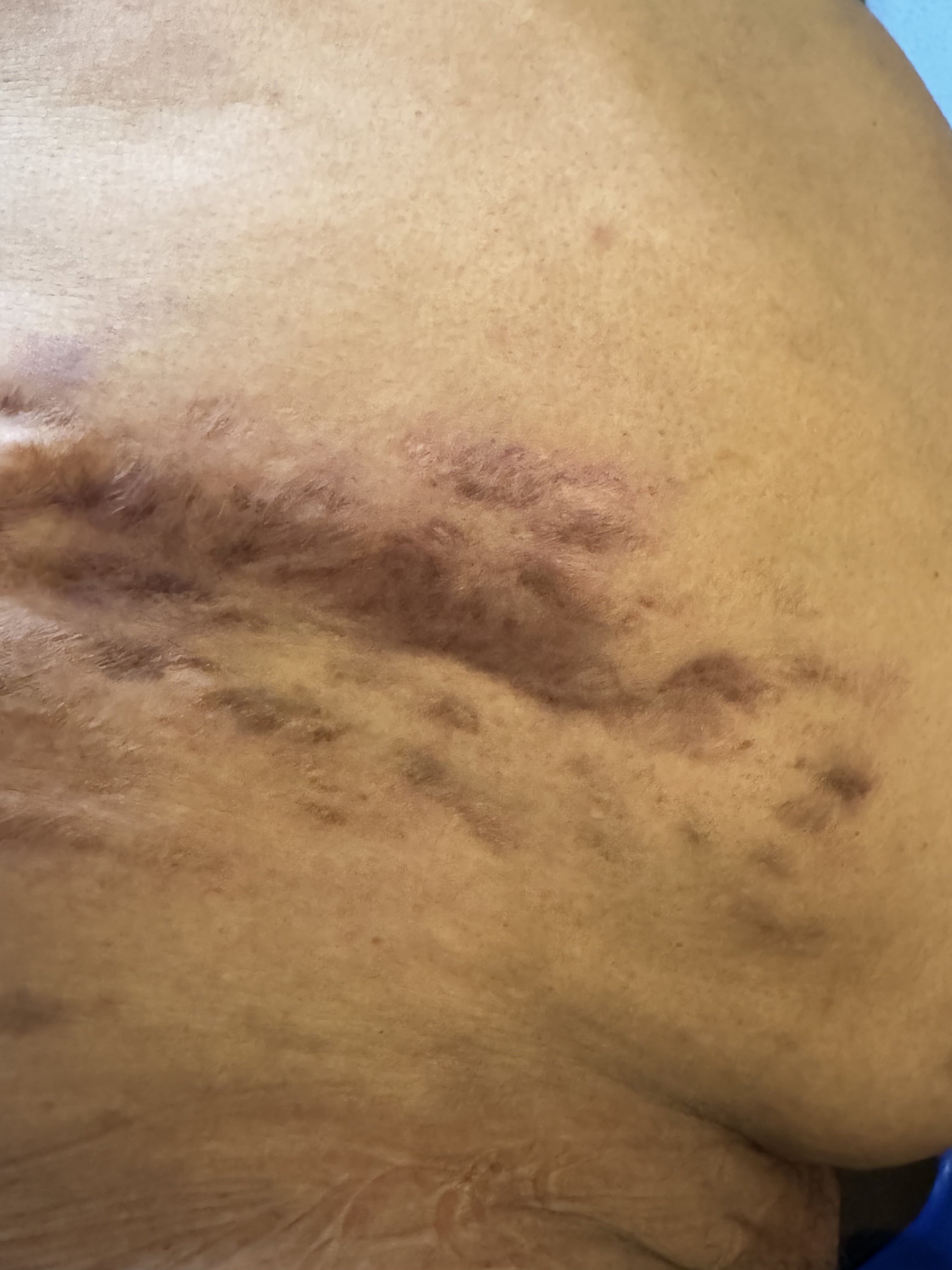 MICETOMA Abdomen - 22 - Mayo 2025