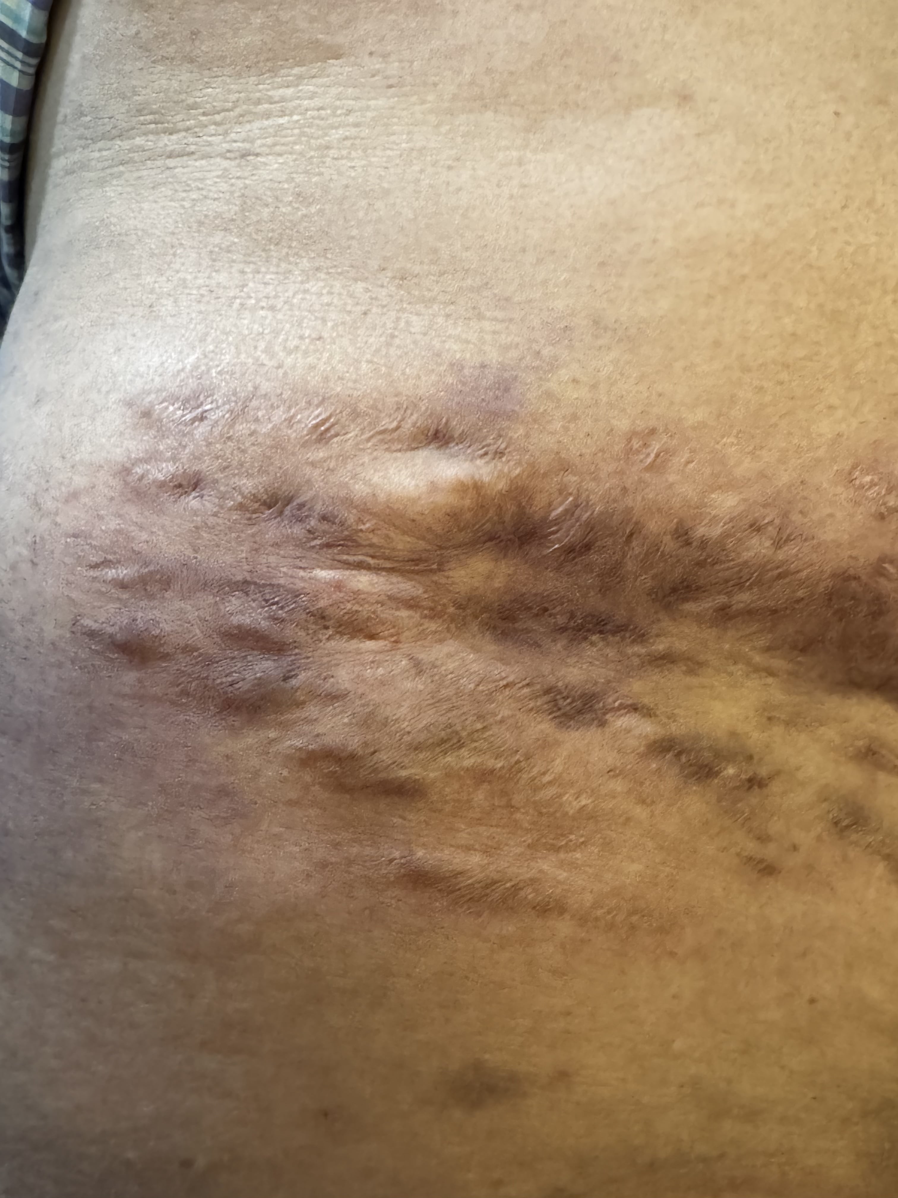 MICETOMA Abdomen - 22 - Mayo 2025