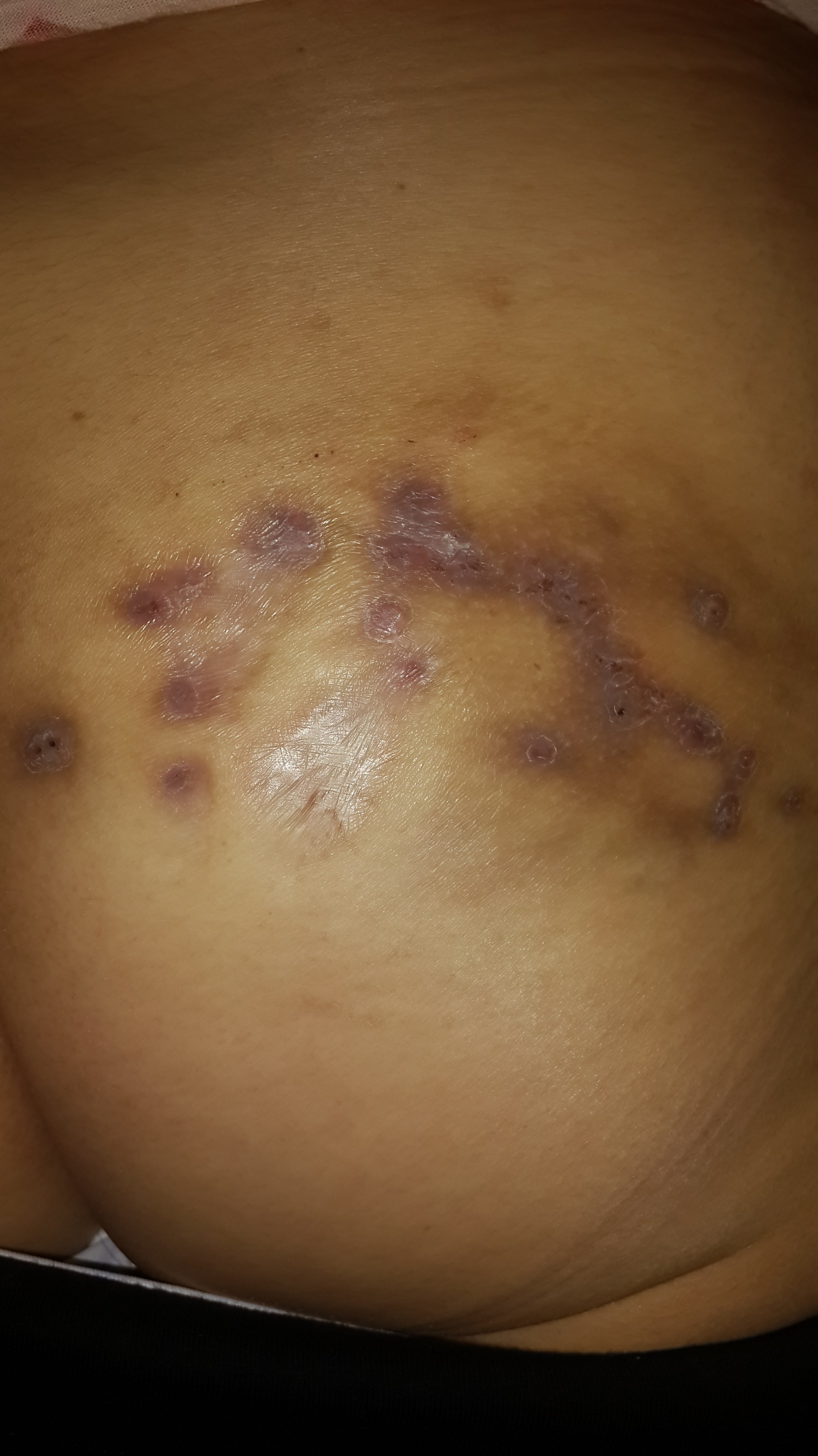 MICETOMA del glúteo