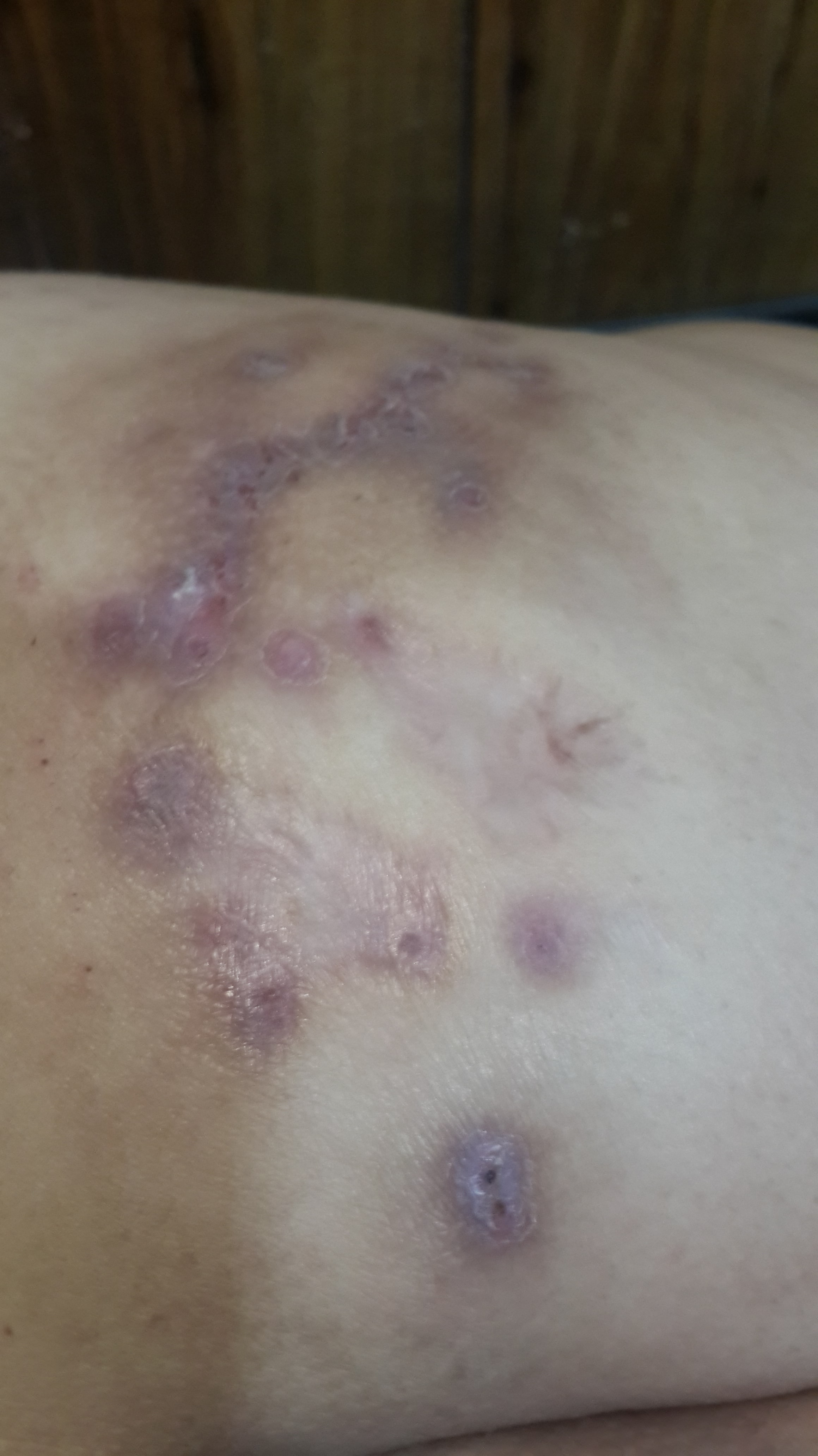 MICETOMA del glúteo