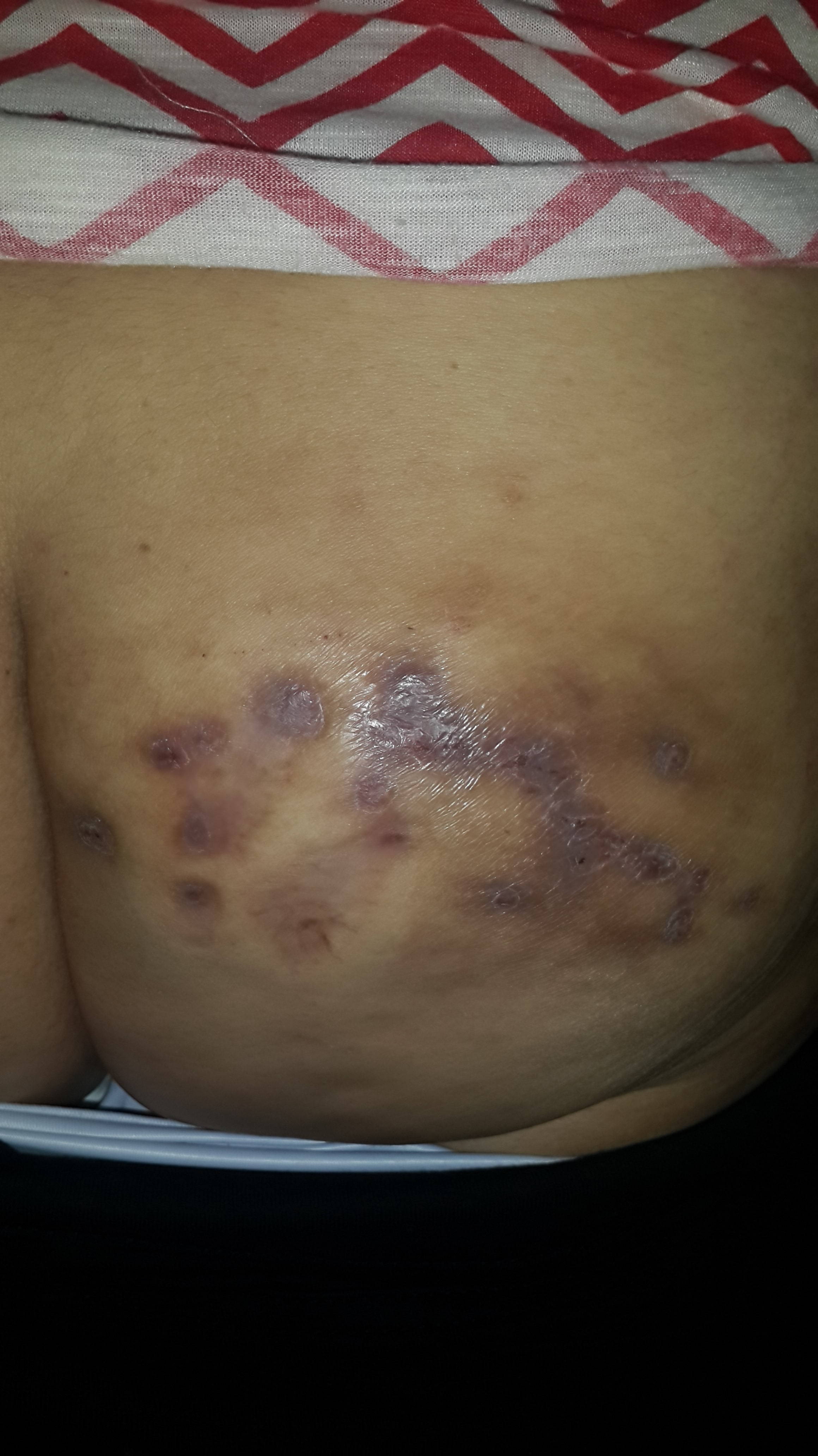 MICETOMA del glúteo