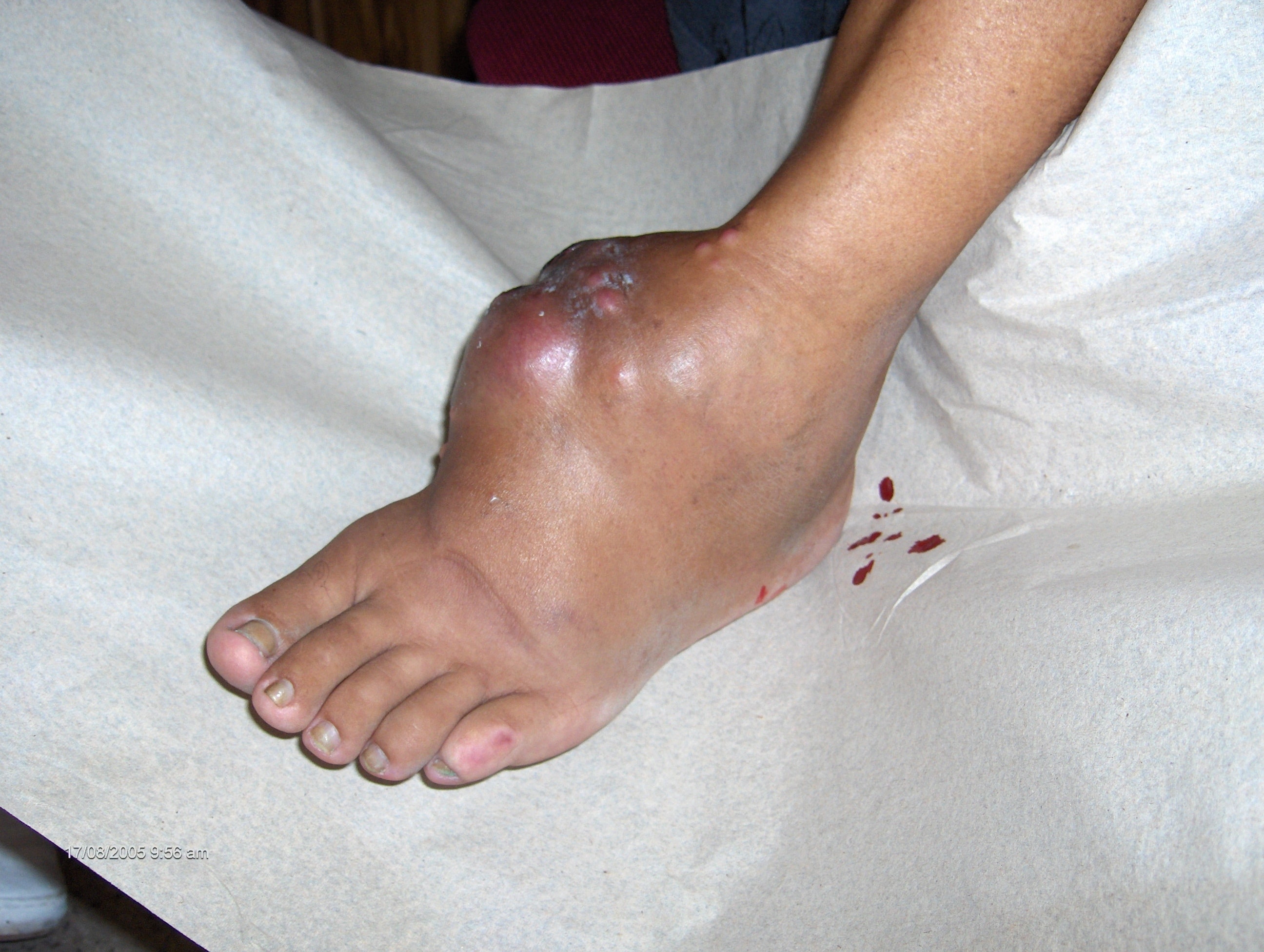 MICETOMA del pie - tobillo izquierdo