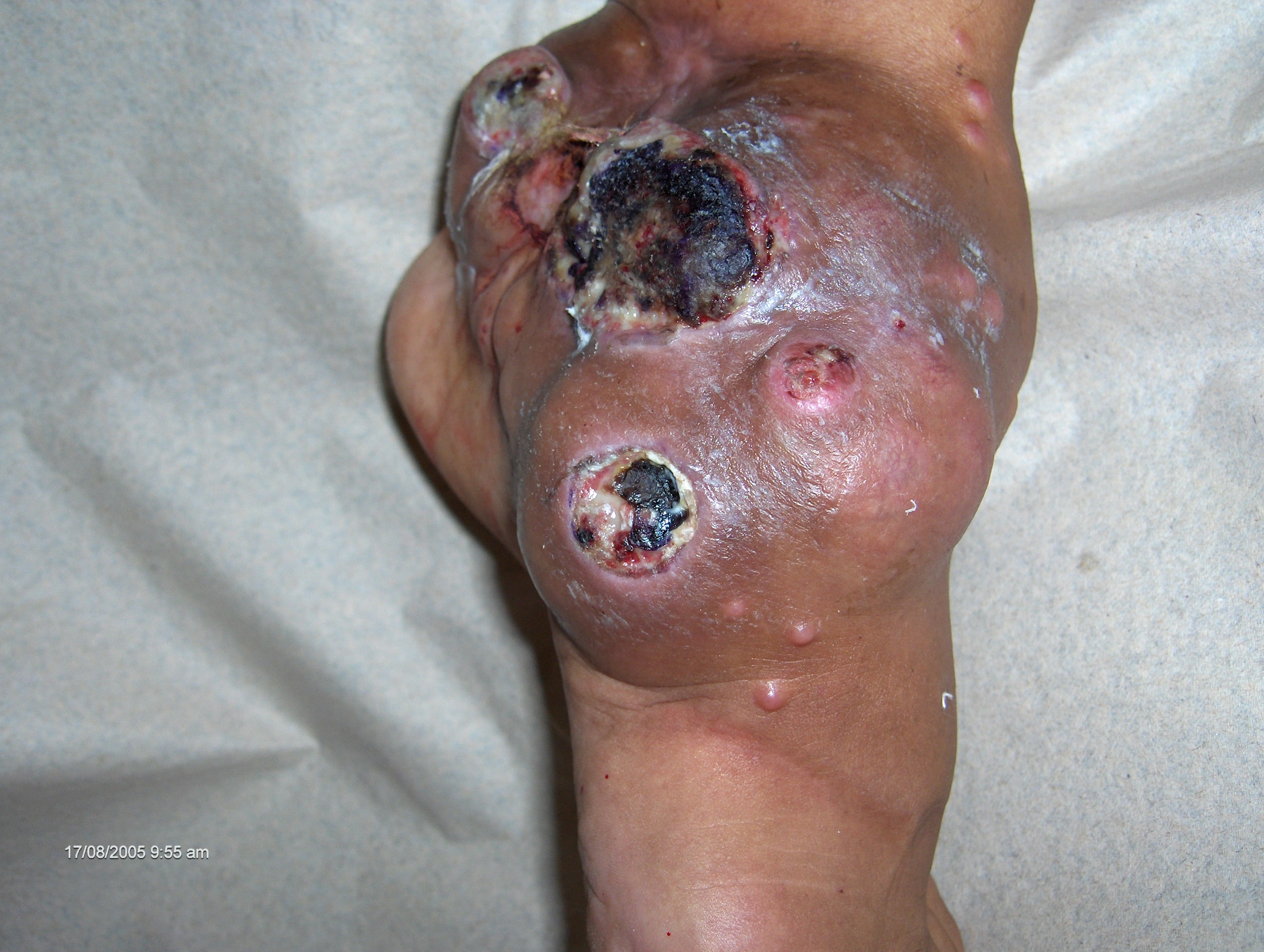 MICETOMA del pie - tobillo izquierdo