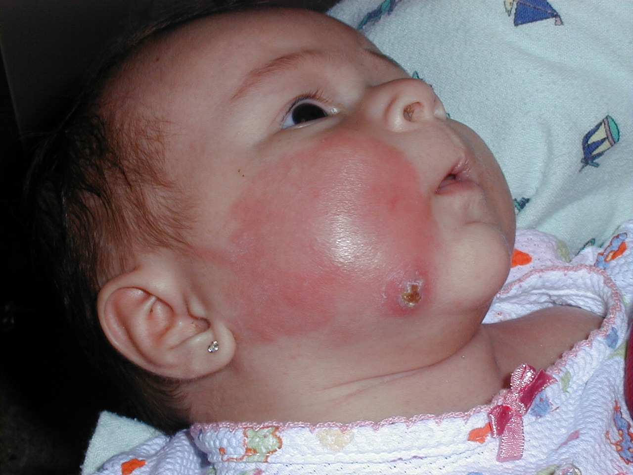CELULITIS de la cara en infante