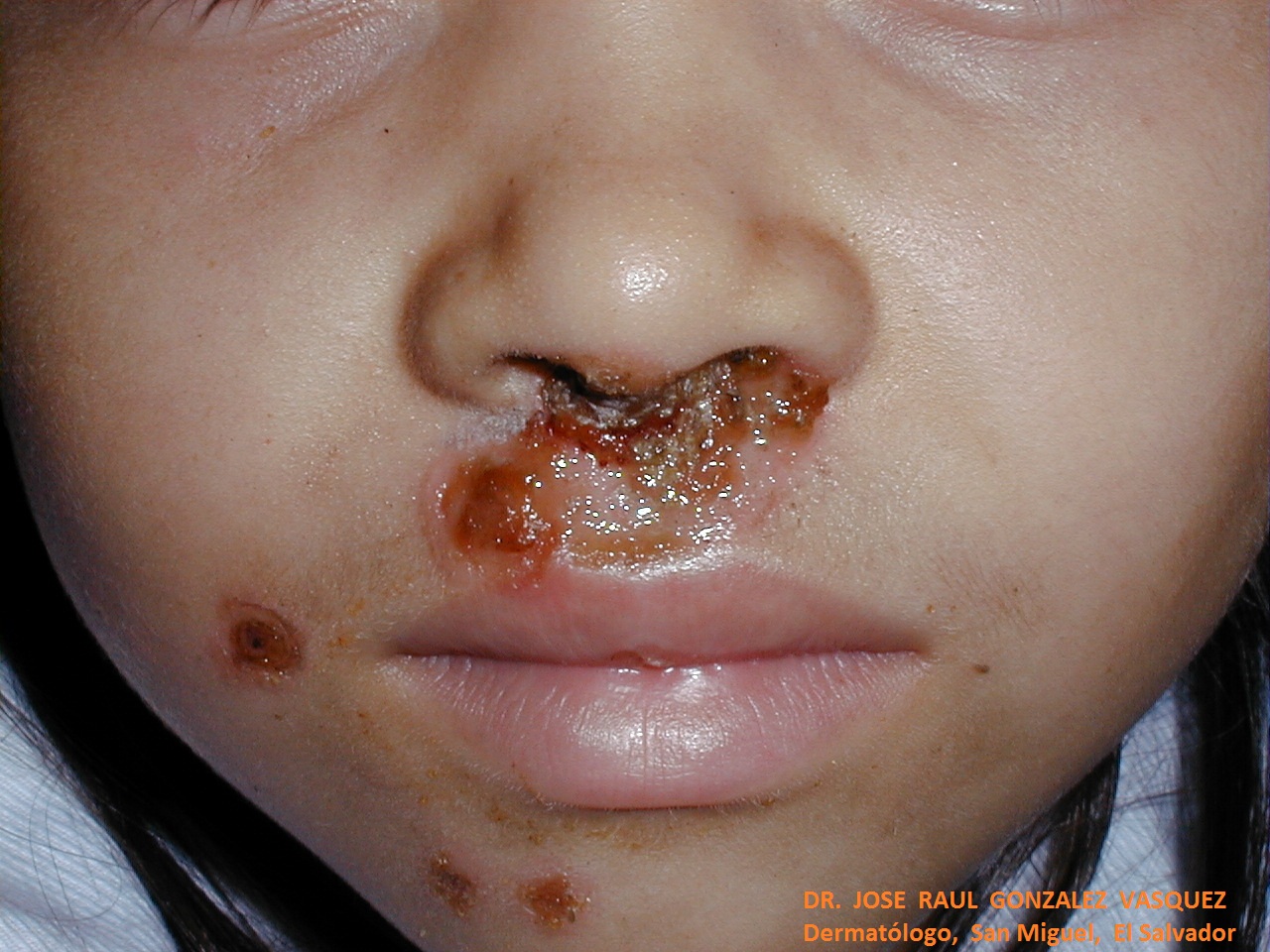 IMPETIGO COSTROSO