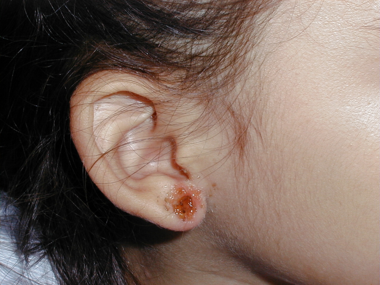 IMPETIGO COSTROSO