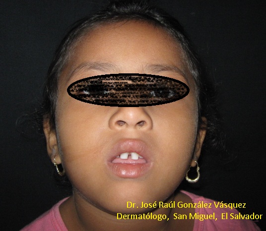 IMPETIGO COSTROSO - Curación