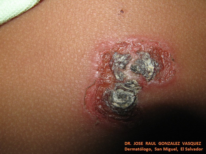 IMPETIGO COSTROSO