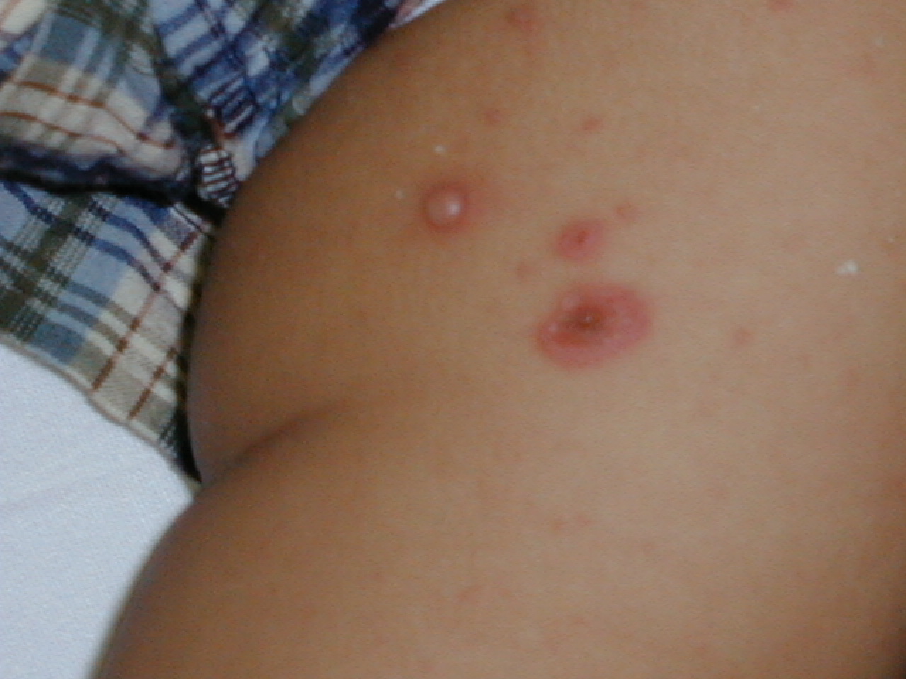 IMPETIGO AMPOLLOSO