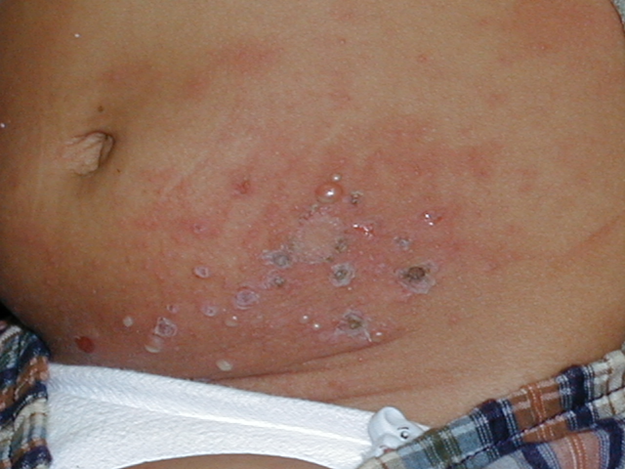 IMPETIGO AMPOLLOSO