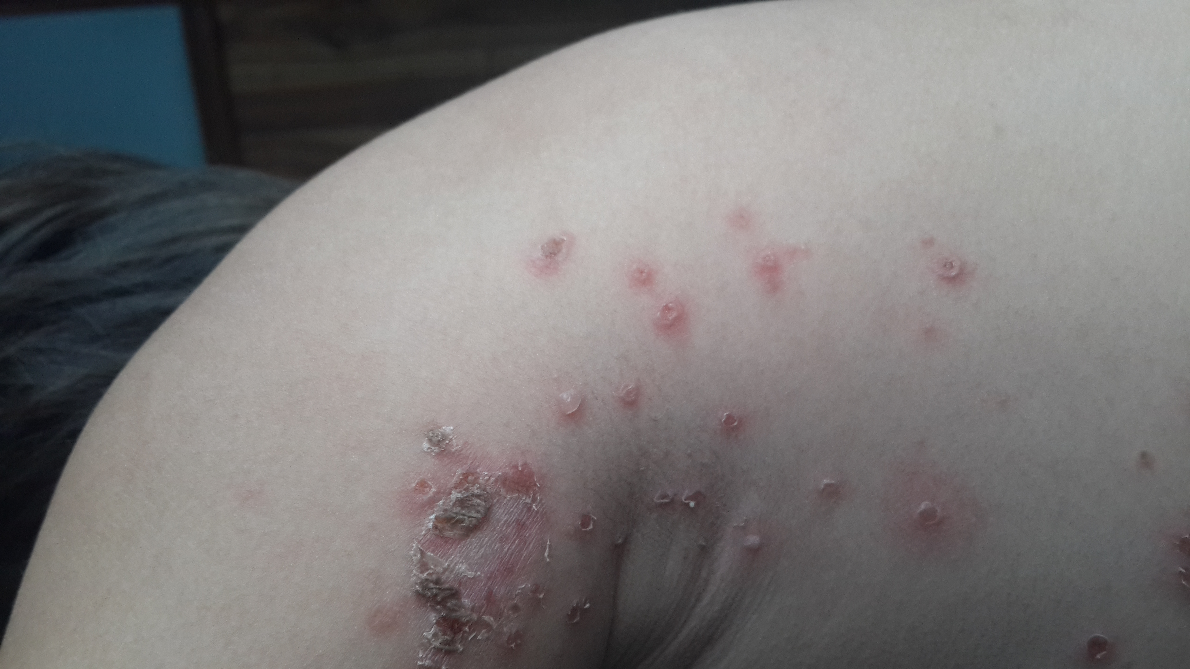 IMPETIGO Costroso y Ampolloso