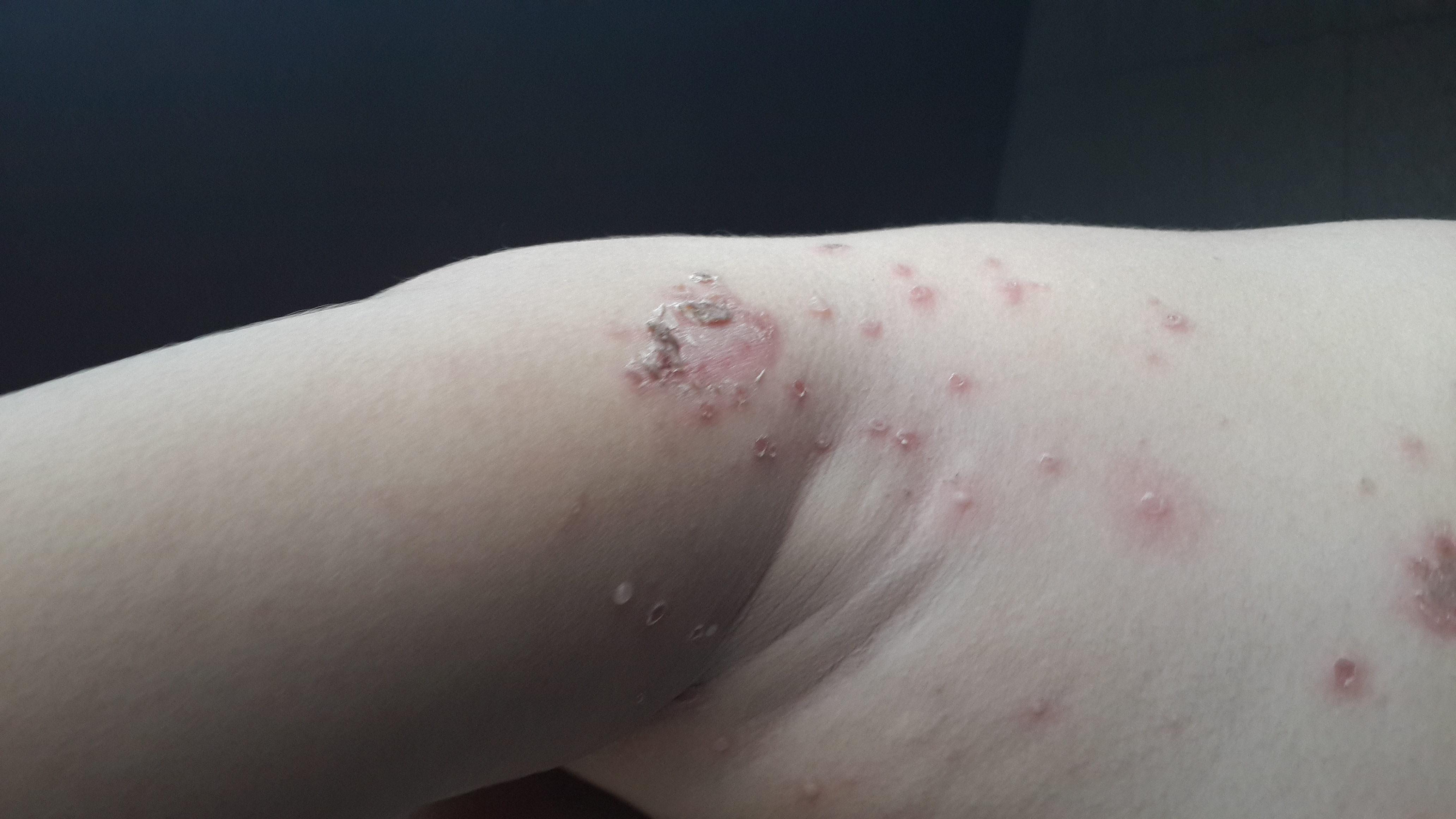 IMPETIGO Costroso y Ampolloso