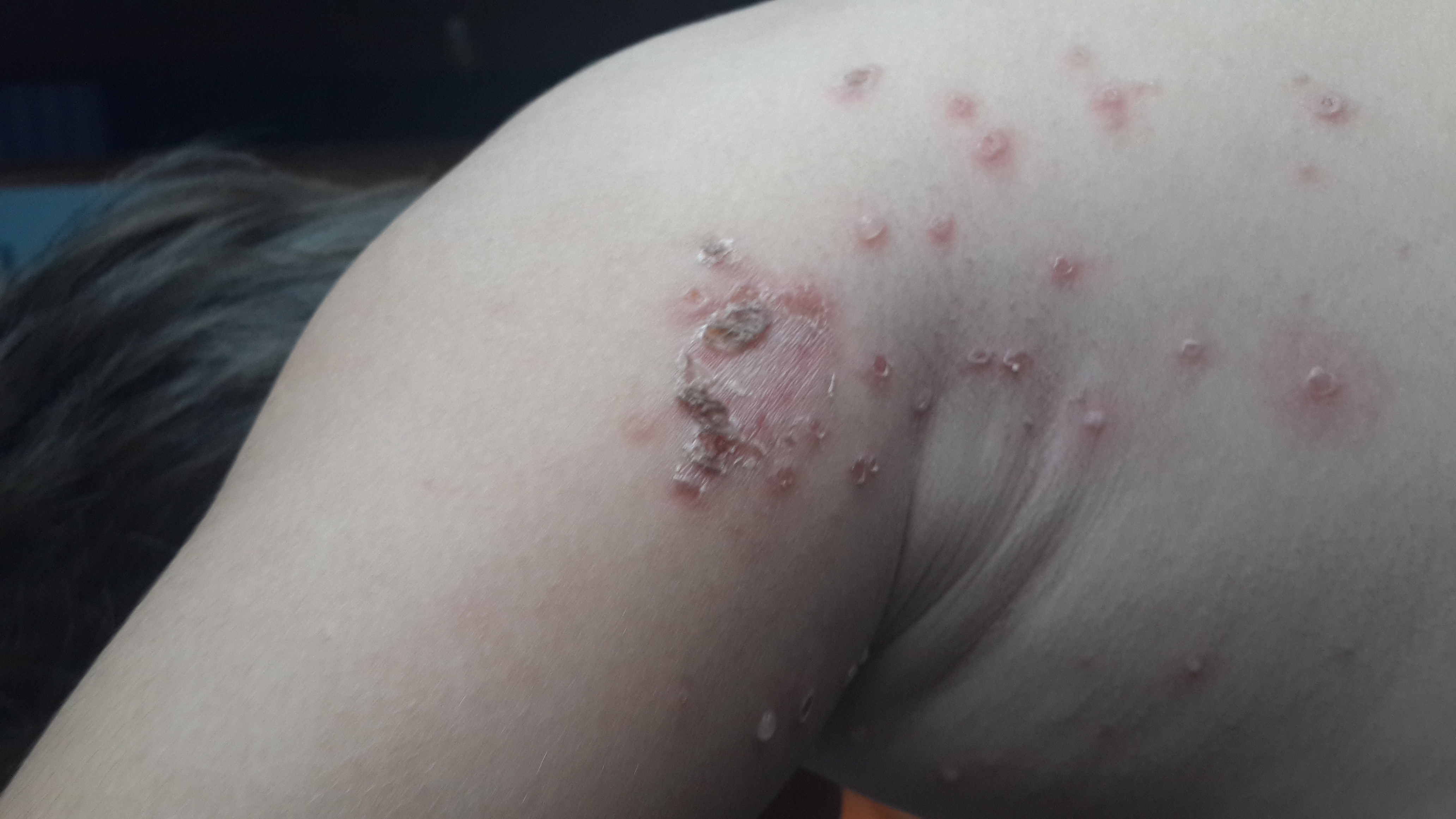 IMPETIGO Costroso y Ampolloso